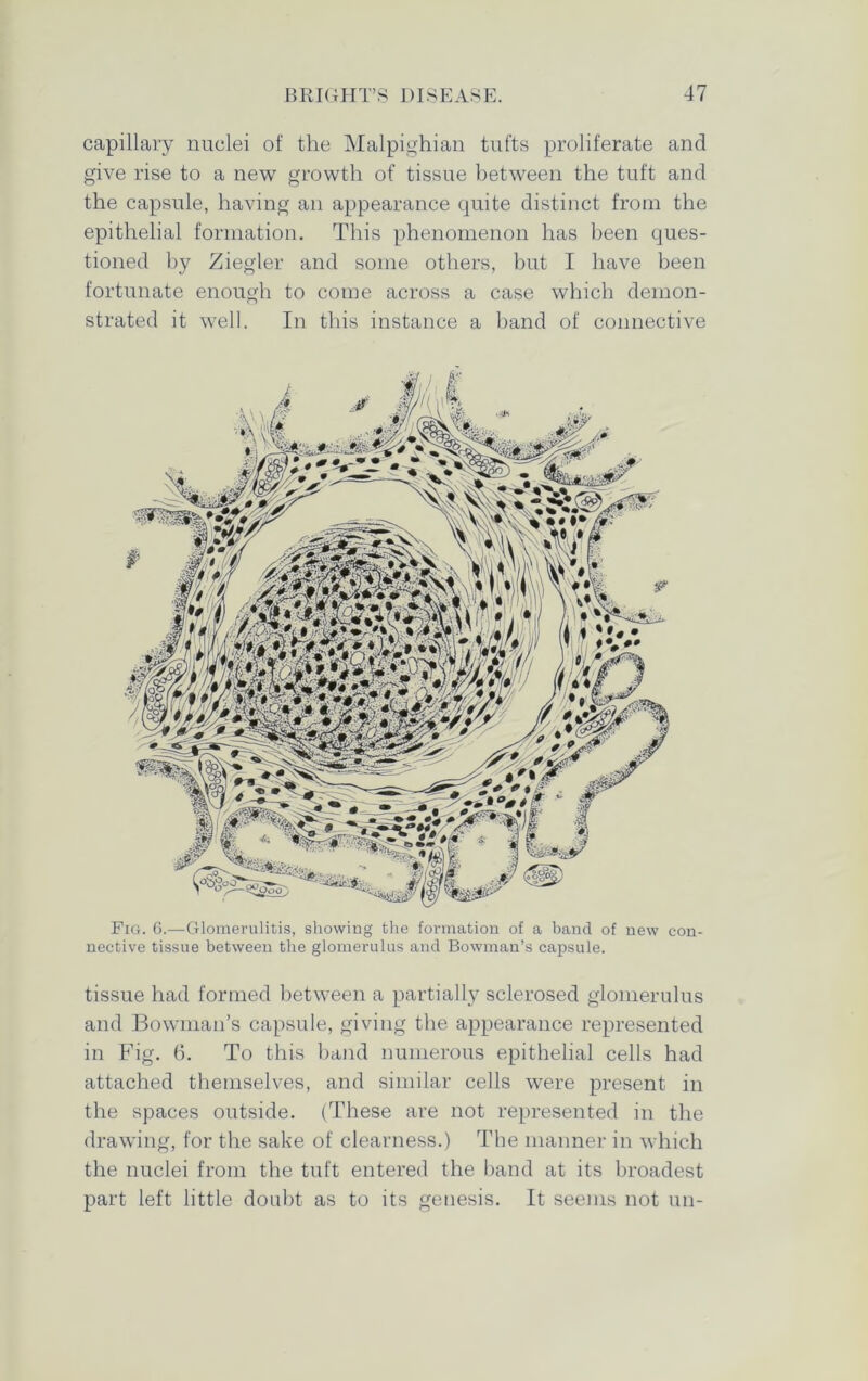capillary nuclei of the Malpighian tufts proliferate and give rise to a new growth of tissue between the tuft and the capsule, having an appearance quite distinct from the epithelial formation. This phenomenon has been ques- tioned by Ziegler and some others, but I have been fortunate enough to come across a case which demon- strated it well. In this instance a band of connective Fig. 6.—Glomerulitis, showing the formation of a band of new con- nective tissue between the glomerulus and Bowman’s capsule. tissue had formed between a partially sclerosed glomerulus and Bowman’s capsule, giving the appearance represented in Fig. 6. To this band numerous epithelial cells had attached themselves, and similar cells were present in the spaces outside. (These are not represented in the drawing, for the sake of clearness.) The manner in which the nuclei from the tuft entered the band at its broadest part left little doubt as to its genesis. It seems not un-