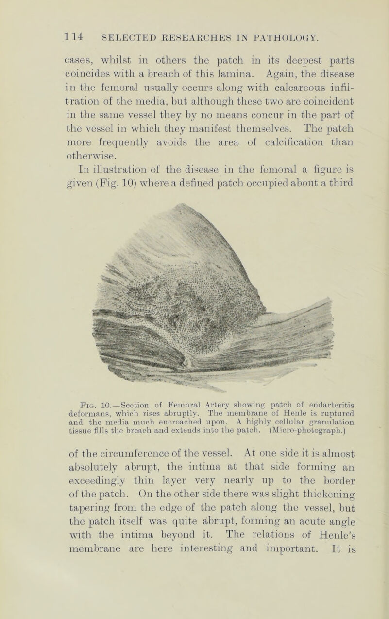 cases, whilst in others the patch in its deepest parts coincides with a breach of this lamina. Again, the disease in the femoral usually occurs along with calcareous infil- tration of the media, but although these two are coincident in the same vessel they by no means concur in the part of the vessel in which they manifest themselves. The patch more frequently avoids the area of calcification than otherwise. In illustration of the disease in the femoral a figure is given (Fig. 10) where a defined patch occupied about a third Fig. 10.—Section of Femoral Artery showing patch of endarteritis deformans, which rises abruptly. The membrane of Henle is ruptured and the media much encroached upon. A highly cellular granulation tissue fills the breach and extends into the patch. (Micro-photograph.) of the circumference of the vessel. At one side it is almost absolutely abrupt, the intima at that side forming an exceedingly thin layer very nearly up to the border of the patch. On the other side there was slight thickening tapering from the edge of the patch along the vessel, but the patch itself was quite abrupt, forming an acute angle with the intima beyond it. The relations of Henle’s membrane are here interesting and important. It is