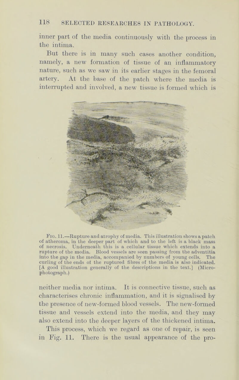 inner part of the media continuously with the process in the intima. But there is in many such cases another condition, namely, a new formation of tissue of an inflammatory nature, such as we saw in its earlier stages in the femoral artery. At the base of the patch where the media is interrupted and involved, a new tissue is formed which is Fig. 11.—Rupture and atrophy of media. This illustration shows a patch of atheroma, in the deeper part of which and to the left is a black mass of necrosis. Underneath this is a cellular tissue which extends into a rupture of the media. Blood vessels are seen passing from the adventitia into the gap in the media, accompanied by numbers of young cells. The curling of the ends of the ruptured fibres of the media is also indicated. [A good illustration generally of the descriptions in the text.] (Micro- photograph.) neither media nor intima. It is connective tissue, such as characterises chronic inflammation, and it is signalised by the presence of new-formed blood vessels. The new-formed tissue and vessels extend into the media, and they may also extend into the deeper layers of the thickened intima. This process, which we regard as one of repair, is seen in Fig. 11. There is the usual appearance of the pro-