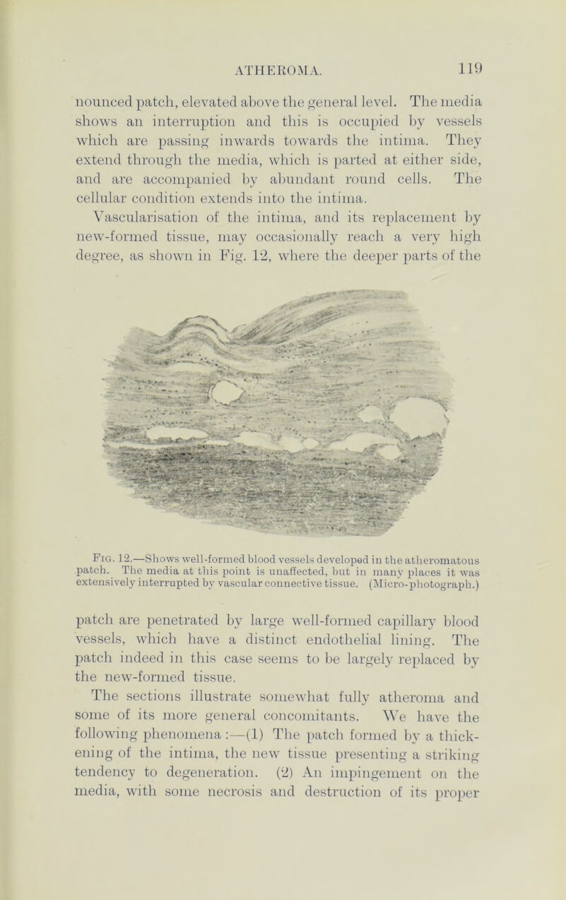 nounced patch, elevated above the general level. The media shows an interruption and this is occupied by vessels which are passing inwards towards the intima. They extend through the media, which is parted at either side, and are accompanied by abundant round cells. The cellular condition extends into the intima. Yascularisation of the intima, and its replacement by new-formed tissue, may occasionally reach a very high degree, as shown in Fig. 12, where the deeper parts of the Fig. 12.—Shows well-formed blood vessels developed in the atheromatous patch. The media at this point is unaffected, but in many places it was extensively interrupted by vascular connective tissue. (Micro-photograph.) patch are penetrated by large well-formed capillary blood vessels, which have a distinct endothelial lining. The patch indeed in this case seems to be largely replaced by the new-formed tissue. The sections illustrate somewhat fully atheroma and some of its more general concomitants. We have the following phenomena :—(1) The patch formed by a thick- ening of the intima, the new tissue presenting a striking tendency to degeneration. (2) An impingement on the media, with some necrosis and destruction of its proper