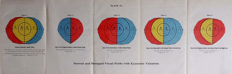 Figure 1. normal Binocular Ulsual field. The yellow area is the portion common to both eyes; the red belongs to the left and the blue to the monocular field of the right eye. The heavjr black circles divide the fields into three zones of equal economic importance. Chapter VI, § 13. ■ Figure 2. Coss of the temporal halves of Both Ulsual fields Valuation of the Remainder is % of the Normal. Chapter IX, § 19. PLATE IV. Figure 3. Coss of the nasal Halves of Both Ulsual fields. Valuation of the Remainder is 1. Chapter IX, §19. Figure 4. Coss of Hie nasal Half of the Ulsual field of the Ceft Eye. Valuation of the Remainder is 1. Chapter IX, § 19. Figure 5. Coss of the temporal Half of the Ulsual field of the Right Eye. Valuation of the Remainder is X • Chapter IX, §19. Normal and Damaged Visual Fields with Economic Valuation.