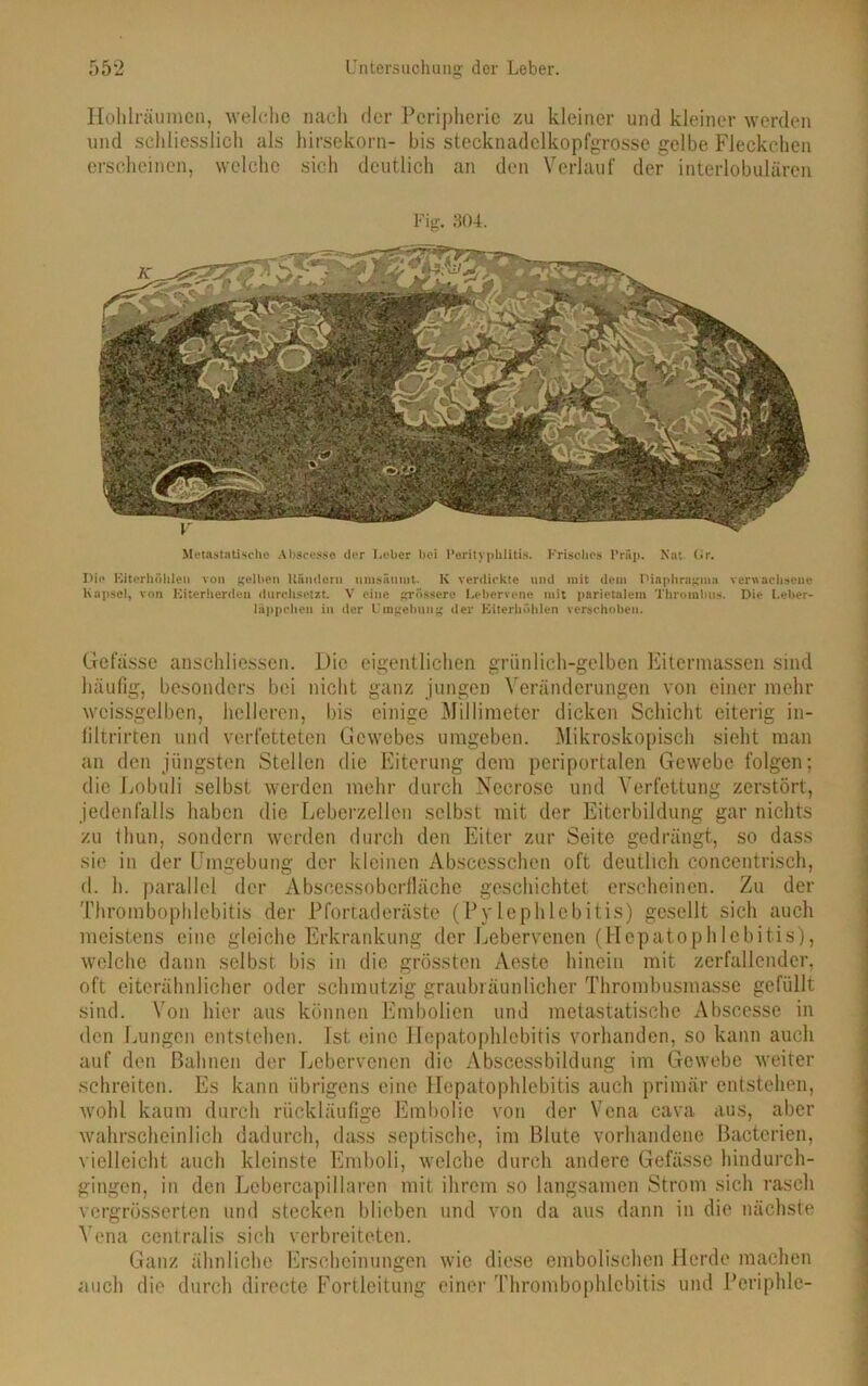 Hohlräumen, welche nach der Peripherie zu kleiner und kleiner werden und schliesslich als hirsekorn- bis stecknadelkopfgrosse gelbe Fleckchen erscheinen, welche sich deutlich an den Verlauf der interlobulären Fig. 304. Metastatische Abscesse der Leber bei Perityphlitis. Frisches Präp. Nat. Gr. Die Eiterhöhleii von gellten Uäntlern nmsiitnnt. K verdickte und mit dem Diaphragma verwachsene Kapsel, von Eiterherden durchsetzt. V eine grössere Lebervene mit parietalem Thrombus. Die Leber- läppchen in der Umgehung der Eiterhöhlen verschoben. Gefässc anschliessen. Die eigentlichen grünlich-gelben Eitermassen sind häufig, besonders bei nicht ganz jungen Veränderungen von einer mehr wcissgelben, helleren, bis einige Millimeter dicken Schicht eiterig in- filtrirten und verfetteten Gewebes umgeben. Mikroskopisch sieht man an den jüngsten Stellen die Eiterung dem periportalen Gewebe folgen; die Lobuli selbst werden mehr durch Necrose und Verfettung zerstört, jedenfalls haben die Leberzellen selbst mit der Eiterbildung gar nichts zu thun, sondern werden durch den Eiter zur Seite gedrängt, so dass sie in der Umgebung der kleinen Abscesschen oft deutlich concentrisch, d. h. parallel der Abseessobcrfläche geschichtet erscheinen. Zu der Thrombophlebitis der Pfortaderäste (Pylephlebitis) gesellt sich auch meistens eine gleiche Erkrankung der Lebervenen (Hepatophlebitis), welche dann selbst bis in die grössten Aeste hinein mit zerfallender, oft eiterähnlicher oder schmutzig graubräunlicher Thrombusmasse gefüllt sind. Von hier aus können Embolien und metastatische Abscesse in den Lungen entstehen, ist. eine Hepatophlebitis vorhanden, so kann auch auf den Bahnen der Lebervenen die Abscessbildung im Gewebe weiter schreiten. Es kann übrigens eine Hepatophlebitis auch primär entstellen, wohl kaum durch rückläufige Embolie von der Vena cava aus, aber wahrscheinlich dadurch, dass septische, im Blute vorhandene Bacterien, vielleicht auch kleinste Emboli, welche durch andere Gefässe hindurch- gingen, in den Lebercapillaren mit ihrem so langsamen Strom sich rasch vergrösserten und stecken blieben und von da aus dann in die nächste Vena centralis sich verbreiteten. Ganz ähnliche Erscheinungen wie diese embolischen Herde machen auch die durch directe Fortlcitung einer Thrombophlebitis und Periphlc-