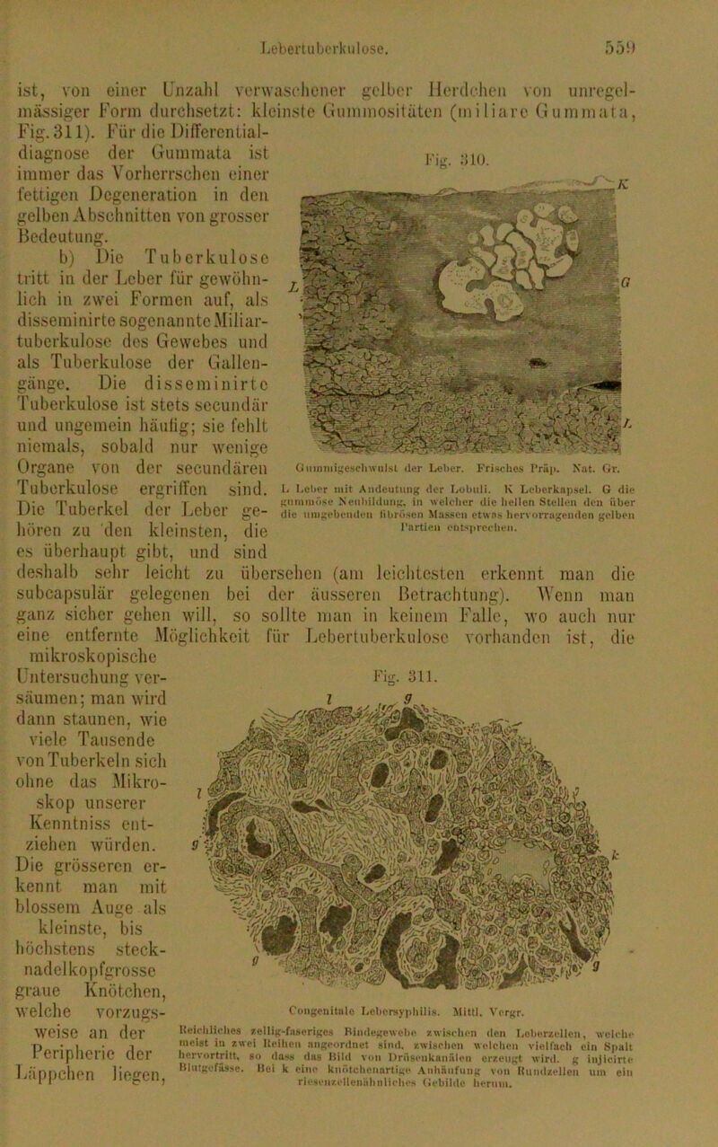 Lebertuberkulose. 55 t) ist, von einer Unzahl verwaschener gelber Herdchen von unregel- mässiger Form durchsetzt: kleinste Gummositäten (miliare Gummata, Fig. 311). Für die Differential- diagnose der Gummata ist immer das Vorherrschen einer fettigen Degeneration in den gelben Abschnitten von grosser Bedeutung. b) Die Tuberkulose tritt in der Leber für gewöhn- lich in zwei Formen auf, als disseminirte sogenannte .Miliar- tuberkulose des Gewebes und als Tuberkulose der Gallen- gänge. Die disseminirte Tuberkulose ist stets sccundär und ungemein häufig; sie fehlt niemals, sobald nur wenige Organe von der secundären Tuberkulose ergriffen sind. Die Tuberkel der Leber hören zu den kleinsten, es überhaupt gibt, und deshalb sehr leicht zu subcapsulär gelegenen bei ganz sicher gehen will, so Fig. 310. ge- Gtnnmigescli willst der Leber. Frisches Präp. Nat. Gr. I. Leber mit Andeutung der Lobuli. K Leberkapsel. G die gummöse Neubildung, in welcher die hellen Stellen den über die umgebenden fibrösen Massen etwas hervorragenden gelben Partien entsprechen. die sind übersehen (am leichtesten erkennt man die der äusseren Betrachtung). Wenn man sollte man in keinem Falle, wo auch nur eine entfernte Möglichkeit mikroskopische Untersuchung ver- säumen; man wird dann staunen, wie viele Tausende von Tuberkeln sicli ohne das Mikro- skop unserer Kenntniss ent- ziehen würden. Die grösseren er- kennt man mit blossem Auge als kleinste, bis höchstens steck- nadelkopfgrosse graue Knötchen, welche vorzugs- weise an der Peripherie der Läppchen liegen, für Lebertuberkulosc vorhanden ist, die Fier. 311. Congenitale Lebersyphilis. Mittl. Vorgr. lleichliehes zeilig-faseriges Bindegewebe zwischen den Leberzellen, welche meist in zwei Itidheu angeordnet sind, zwischen welchen vielfach ein Spalt hervortritt, so dass das Bild von Dritsenkanälen erzeugt wird, g injicirte Blutgefässe. Bei k eine knötchenartige Anhäufung von itundzelleu um ein riesenzelleniihnliclies Gebilde herum.