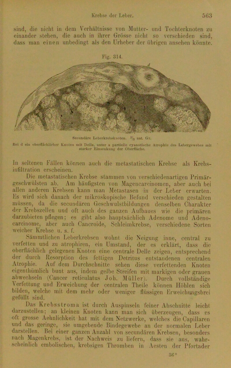 sind, die nicht in dem Verhältnisse von Mutter- und Tochterknoten zu einander stehen, die auch in ihrer Grösse nicht so verschieden sind, dass man einen unbedingt als den Urheber der übrigen ansehen könnte. Secnndäre Leberkrebsknoten. 2/3 nab Gr. Bri d ein oberflichlichor Knoten mit Delle, unter a partielle cyanotiscbe Atrophie des Lebergewebes mit starker Binseuknng der Oberfläche. Tn seltenen Fällen können auch die metastatischen Krebse als Krebs- infiltration erscheinen. Die metastatischen Krebse stammen von verschiedenartigen Primär- geschwülsten ab. Am häufigsten von Magcncarcinomen, aber auch bei allen anderen Krebsen kann man Metastasen in der Leber erwarten. Ls wird sich danach der mikroskopische Befund verschieden gestalten müssen, da die sccundären Geschwulstbildungen denselben Charakter der Krebszellen und oft auch des ganzen Aufbaues wie die primären darzubieten pflegen; es gibt also hauptsächlich Adenome und Adeno- carcinome, aber auch Cancroide, .Schleimkrebse, verschiedene Sorten weicher Krebse u. s. f. Sämmtlichen Leberkrebsen wohnt die Neigung inne, central zu verfetten und zu atrophiren, ein Umstand, der es erklärt, dass die oberflächlich gelegenen Knoten eine centrale Delle zeigen, entsprechend der durch Resorption des fettigen Detritus entstandenen centralen Atrophie. Auf dem Durchschnitte sehen diese verfettenden Knoten eigentümlich bunt aus, indem gelbe Streifen mit markigen oder grauen abwechseln (Cancer retioulatus Job. Müller). Durch vollständige Verfettung und Erweichung der centralen Theile können Höhlen sich bilden, welche mit dem mehr oder weniger flüssigen Erweichiuigsbrei gefüllt sind. Das Krebsstroma ist durch Auspinseln feiner Abschnitte leicht darzustellen; an kleinen Knoten kann man sich überzeugen, dass cs oft grosse Aehnlichkcit hat mit dem Netzwerke, welches die Capillaren und das geringe, sie umgebende Bindegewebe an der normalen Leber darstellen. Bei einer ganzen Anzahl von sccundären Krebsen, besonders nach Magenkrebs, ist der Nachweis zu liefern, dass sie aus, wahr- scheinlich embolischen, krebsigen Thromben in Aesten der Pfortader 36*