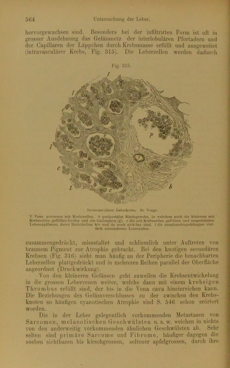 hervorgewachsen sind. Besonders bei der infiltrirten Form ist oft in grosser Ausdehnung das Gefässnetz der interlobulären Pfortadern und der Capillaren der Läppchen durch Krebsmasse erfüllt und ausgeweitet (intravasculärer Krebs, Fig. 315). Die Leberzellen werden dadurch Fig. 315. Intravasculärer Leberkrebs. St. Vergr. V Vena portarum mit Krebszellen, b periportales Bindegewebe, in welchem noch ein kleineres mit Krebszellen gefülltes Cieläss und ein Gallengang (g). c die mit Krebszellen gefüllten und ausgedehnten Lebercapillaren, deren Kndothelien hie und da noch sichtbar sind. 1 die auseinandergedrängten viel- fach missstaltcten Leberzellcn. zusammengedrückt, missstaltet und schliesslich unter Auftreten von braunem Pigment zur Atrophie gebracht. Bei den knotigen secundären Krebsen (Fig. 316) sieht man häufig an der Peripherie die benachbarten Leberzellen plattgedrückt und in mehreren Reihen parallel der Oberfläche angeord n et ( D r u ck wirk u n g). Von den kleineren Gelassen geht zuweilen die Krebsentwickelung in die grossen Lebervenen weiter, welche dann mit einem krebsigen Thrombus erfüllt sind, der bis in die Vena cava hineinreichen kann. Die Beziehungen des Gefässverschlusses zu der zwischen den Krebs- knoten so häufigen cyanotischen Atrophie sind S. 546 schon erörtert worden. Die in der Leber gelegentlich vorkommenden Metastasen von Sarcomen, melanotischen Geschwülsten u. s. w. weichen in nichts von den anderweitig vorkommenden ähnlichen Geschwülsten ab. Sehr selten sind primäre Sareome und Fibrome, häufiger dagegen die soeben sichtbaren bis kirschgrossen, seltener apfelgrossen, durch ihre