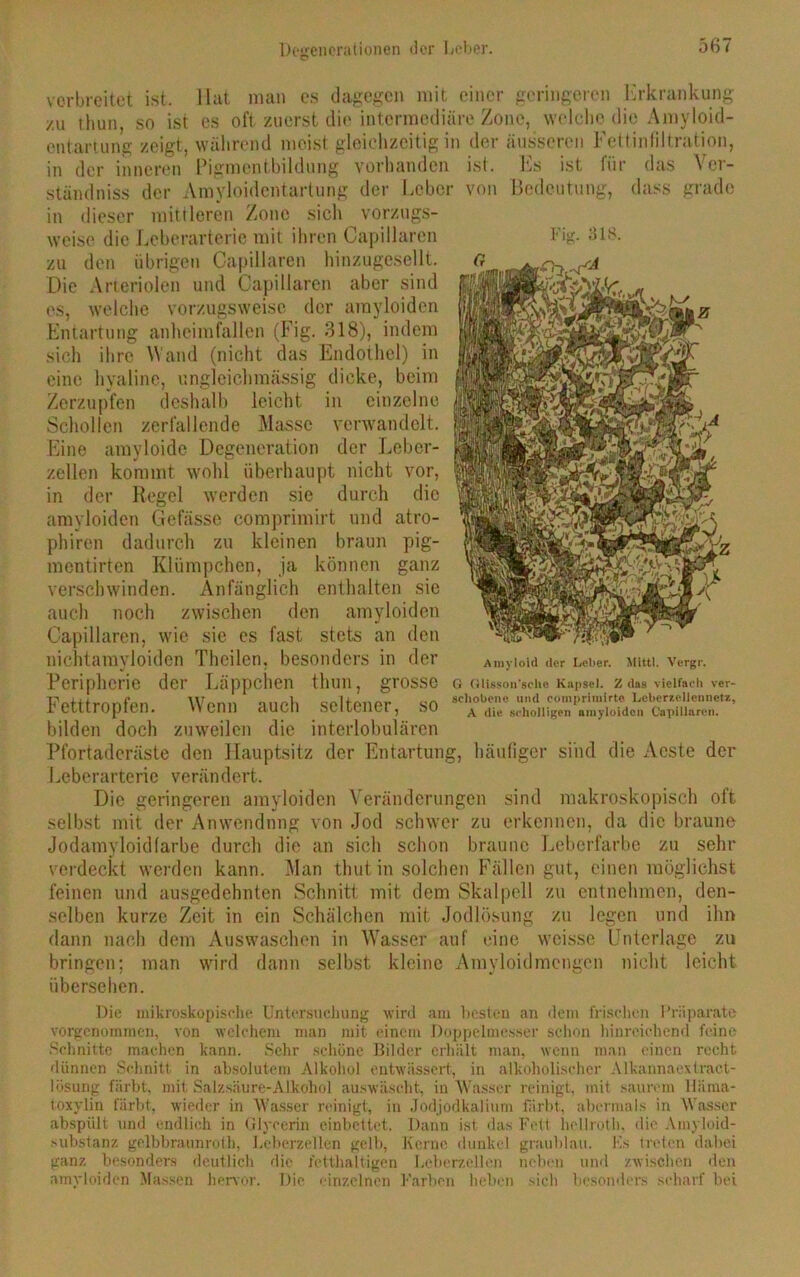 Degenerationen der Leber. verbreitet ist. Hat man es dagegen mit einer geringeren Erkrankung zu thun, so ist es oft zuerst die intermediäre Zone, welche die Amyloid- entartung zeigt, während meist gleichzeitig in der äusseren Fettinfiltration, in der inneren Pigmentbildung vorhanden ist. Es ist für das \ er- ständniss der Amyloidentartung der Leber von Bedeutung, dass grade in dieser mittleren Zone sich vorzugs- weise die Leberarterie mit ihren Capillaren zu den übrigen Capillaren hinzugesellt. Die Arteriolen und Capillaren aber sind es, welche vorzugsweise der amyloiden Entartung anheimfallen (Fig. 318), indem sich ihre Wand (nicht das Endothel) in eine hyaline, ungleiehmässig dicke, beim Zerzupfen deshalb leicht in einzelne Schollen zerfallende Masse verwandelt. Eine arayloide Degeneration der Leber- zellen kommt wohl überhaupt nicht vor, in der Regel werden sie durch die amyloiden Gefässe comprimirt und atro- phiren dadurch zu kleinen braun pig- mentirten Klümpchen, ja können ganz verschwinden. Anfänglich enthalten sie auch noch zwischen den amyloiden Capillaren, wie sie es fast stets an den nichtamyloiden Theilen, besonders in der Peripherie der Läppchen thun, grosse Fetttropfen. Wenn auch seltener, so bilden doch zuweilen die interlobulären Pfortaderäste den Hauptsitz der Entartung, häufiger sind die Acste der Leberarterie verändert. Die geringeren amyloiden Veränderungen sind makroskopisch oft selbst mit der Amvendnng von Jod schwer zu erkennen, da die braune Jodamyloidfarbe durch die an sich schon braune Leberfarbe zu sehr verdeckt werden kann. Man thut in solchen Fällen gut, einen möglichst feinen und ausgedehnten Schnitt mit dem Skalpell zu entnehmen, den- selben kurze Zeit in ein Schälchen mit Jodlösung zu legen und ihn dann nach dem Auswaschen in Wasser auf eine weisse Unterlage zu bringen; man wird dann selbst kleine Amyloidmengen nicht leicht übersehen. Die mikroskopische Untersuchung wird am besten an dem frischen Präparate vorgenommen, von welchem man mit einem Doppelmesser schon hinreichend feine Schnitte machen kann. Sehr schöne Bilder erhält man, wenn man einen recht dünnen Schnitt in absolutem Alkohol entwässert, in alkoholischer Alkannaextract- lösung färbt, mit Salzsäure-Alkohol auswäscht, iu Wasser reinigt, mit saurem Uiima- toxylin färbt, wieder in Wasser reinigt, in Jodjodkalium färbt, abermals in Wasser abspült und endlich in Glycerin einbettet. Dann ist das Fett hellroth, die Amyloid- substanz gelbbraunroth, Leberzellen gelb, Kerne dunkel graublau. Fs treten dabei ganz besonders deutlich die fetthaltigen Leberzellen neben und zwischen den amyloiden Massen hervor. Die einzelnen Farben heben sich besonders scharf bei Fig. 318. Amyloid der Leber. Mittl. Vergr. G (ilisson'sche Kapsel. Z das vielfach ver- schobene und comprimirte Leberaellennetz, A die scholligen amyloiden Capillaren.