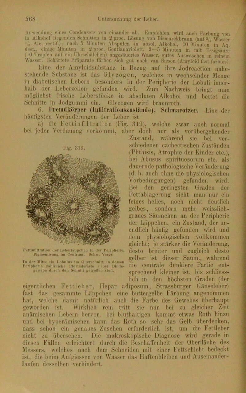 Anwendung eines Condensors von einander ab. Empfohlen wird auch Färbung von in Alkohol liegenden Schnitten in 2 proe. Lösung von Bismarckbraun (auf 2/a Wasser Vs Ale. rectif.): nach 5 Minuten Abspülen in absol. Alkohol, 10 Minuten in Aq. dest., einige Minuten in 2 proe. Gentianaviolett, 3—5 Minuten in mit Essigsäure (10 Tropfen auf ein Uhrschäichen) angesäuertes Wasser, gutes Auswaschen in reinem Wasser. Gehärtete Präparate färben sich gut nach van Gieson (Amyloid fast farblos). Eine der Amyloidsubstanz in Bezug auf ihre Jodreaction nahe- stehende Substanz ist das Glycogen, welches in wechselnder Menge in diabetischen Lehern besonders in der Peripherie der Lobuli inner- halb der Leberzellen gefunden wird. Zum Nachweis bringt man möglichst frische Leberstücke in absoluten Alkohol und bettet die Schnitte in Jodgummi ein. Glycogen wird braunroth. 8. Fremdkörper (Infiltrationszustände), Schmarotzer. Eine der häufigsten Veränderungen der Leber ist a) die Fettinfiltration (Fig. 319), welche zwar auch normal bei jeder Verdauung vorkommt, aber doch nur als vorübergehender Zustand, während sie bei ver- Eig. 311), schiedenen cachectischen Zuständen (Phthisis, Atrophie der Kinder etc.), bei Abusus spirituosorum etc. als dauernde pathologische Veränderung (d. h. auch ohne die physiologischen Vorbedingungen) gefunden wird. Bei den geringsten Graden der Fettablagerung sieht man nur ein feines helles, noch nicht deutlich gelbes, sondern mehr weisslich- graues Säumchen an der Peripherie der Läppchen, ein Zustand, der un- endlich häufig gefunden wird und dem physiologischen vollkommen gleicht; je stärker die Veränderung, desto breiter und zugleich desto gelber ist dieser Saum, während die centrale dunklere Partie ent- sprechend kleiner ist, bis schliess- lich in den höchsten eigentlichen Fettleber, Hepar adiposum, Strassburger fast das gesammte Läppchen eine buttergelbe Färbung hat, welche damit natürlich auch die Farbe des Gewebes überhaupt geworden ist. Wirklich rein tritt sie nur bei zu gleicher Zeit anämischen Lebern hervor, bei bluthaltigen kommt etwas Roth hinzu und bei hypcrämischcn kann das Roth so sehr das Gelb überdecken, dass schon ein genaues Zusehen erforderlich ist, um die Fettleber nicht zu übersehen. Die makroskopische Diagnose wird gerade in diesen Fällen erleichtert: durch die Beschaffenheit der Oberfläche des Messers, welches nach dem Schneiden mit einer Fettschicht bedeckt ist, die beim Aufgiessen von Wasser das Haftenbleiben und Auseinander- laufen desselben verhindert. Fettintiltration der Leberläppchen in der Peripherie, Pigmentirung im Centrum. Schw. Vergr. In der Mitte ein Lobulus im Querschnitt, in dessen Peripherie zahlreiche Pfortaderiiste nebst Binde- gewebe durch den Schnitt getroffen sind. Graden (der Gänseleber) angenommen