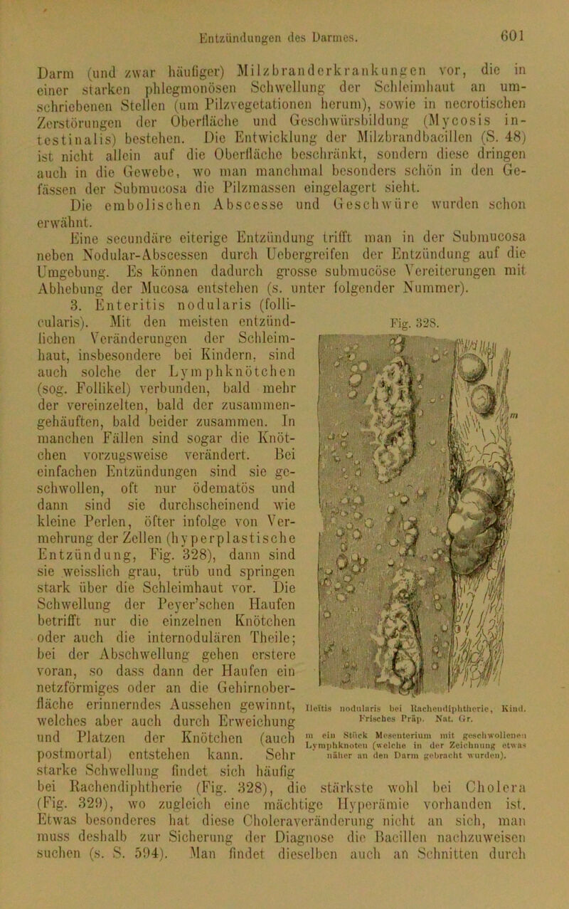 Darm (und zwar häufiger) Milzbranderkrankungen vor einer starken phlegmonösen Schwellung der Schleimhaut Fig. 328. die in an um- schriebenen Stellen i(um Pilzvegetationen herum), sowie in necrotischen Zerstörungen der Oberfläche und Geschwürsbildung (Mycosis in- testinalis) bestehen. Die Entwicklung der Milzbrandbacillen (S. 48) ist nicht allein auf die Oberfläche beschränkt, sondern diese dringen auch in die Gewebe, wo man manchmal besonders schön in den Ge- lassen der Submueosa die Pilzmassen eingelagert sieht. Die embolischen Abscesse und Geschwüre wurden schon erwähnt. Eine secundäre eiterige Entzündung trifft man in der Submueosa neben Nodular-Abscessen durch Uebergreifen der Entzündung auf die Umgebung. Es können dadurch grosse submucöse Vereiterungen mit Abhebung der Mucosa entstehen (s. unter folgender Nummer). 3. Enteritis nodularis (folli- cularis). Mit den meisten entzünd- lichen Veränderungen der Schleim- haut, insbesondere bei Kindern, sind auch solche der Lymphknötchen (sog. Follikel) verbunden, bald mehr der vereinzelten, bald der zusammen- gehäuften, bald beider zusammen. In manchen Fällen sind sogar die Knöt- chen vorzugsweise verändert. Bei einfachen Entzündungen sind sie ge- schwollen, oft nur ödematös und dann sind sie durchscheinend wie kleine Perlen, öfter infolge von Ver- mehrung der Zellen (hy per plastische Entzündung, Fig. 328), dann sind sie weisslich grau, trüb und springen stark über die Schleimhaut vor. Die Schwellung der Peyer’schen Haufen betrifft nur die einzelnen Knötchen oder auch die internodulären Theile; bei der Abschwellung gehen erstere voran, so dass dann der Haufen ein netzförmiges oder an die Gehirnober- fläche erinnerndes Aussehen gewinnt, welches aber auch durch Erweichung und Platzen der Knötchen (auch postmortal) entstehen kann. Sehr starke Schwellung findet sich häufig bei Rachendiphtherie (Fig. 328), die stärkste wohl bei Cholera (Fig. 329), wo zugleich eine mächtige Hyperämie vorhanden ist. Etwas besonderes hat. diese Choleraveränderung nicht an sich, man muss deshalb zur Sicherung der Diagnose die Bacillen nachzuweisen suchen (s. S. 594). Man findet dieselben auch an Schnitten durch cf '• c fl i> ■■ Bür m iWw* Ileitis nodularis bei Racheudiphtherie, Kind. Frisches Präp. Nat. Gr. m ein Stück Mesenterium mit geschwollenen Lymphknoten (welche in der Zeichnung etwas näher an den Darm gebracht wurden).