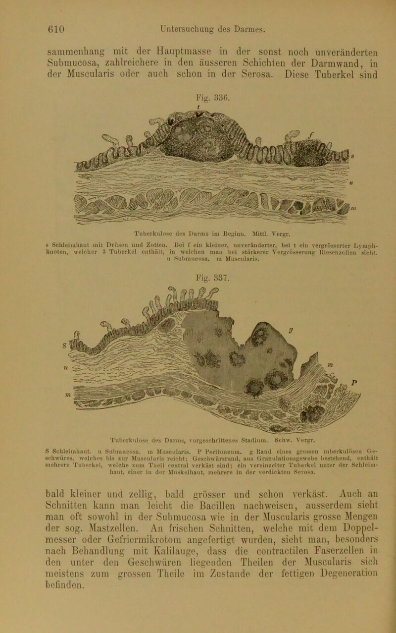 sammenhang mit der Hauptmasse in der sonst noch unveränderten Submucosa, zahlreichere in den äusseren Schichten der Darmwand, in der Muscularis oder auch schon in der Serosa. Diese Tuberkel sind Fig. 836. Tuberkulose des Darms im Beginn. Mittl. Yergr. s Schleimhaut mit Drüsen und Zotten. Hei f ein kleiner, unveränderter, bei t ein vergrösserter Lymph- knoten, welcher 3 Tuberkel enthält, in welchen man bei stärkerer Yergrösserung lliosenzcUeusielit. u Submucosa. m Muscularis. Fig. 337. Tuberkulose des Darms, vorgeschrittenes Stadium. Schw. Vergr. ß Schleimhaut, u Submucosa. in Muscularis. 1* Peritoneum, g Kami eines grossen tuberkulösen Ge- schwüres. welches bis zur Muscularis reicht; Geschwürs rund, ans Granulationsgewebe bestehend, enthält mehrere Tuberkel, welche zum Thcil central verkäst sind; ein vereinzelter Tuberkel unter der Schleim- haut, einer in der Muskelhaut, mehrere in der verdickten Serosn. bald kleiner und zellig, bald grösser und schon verkäst. Auch an Schnitten kann man leicht die Bacillen nachweisen, ausserdem sicht man oft sowohl in der Submucosa wie in der Muscularis grosse Mengen der sog. Mastzellen. An frischen Schnitten, welche mit dem Doppel- messer oder Gefriermikrotom angefertigt wurden, sicht man, besonders nach Behandlung mit Kalilauge, dass die contractilen Faserzcllen in den unter den Geschwüren liegenden Theilen der Muscularis sich meistens zum grossen Theile im Zustande der fettigen Degeneration befinden.