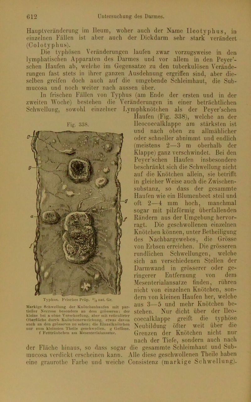 Hauptveränderung im Ileura, woher auch der Name Ueotyphus, in einzelnen Fällen ist aber auch der Dickdarm sehr stark verändert (Colotyphus). Die typhösen Veränderungen laufen zwar vorzugsweise in den lymphatischen Apparaten des Darmes und vor allem in den Peyer’- schen Haufen ab, welche im Gegensätze zu den tuberkulösen Verände- rungen fast stets in ihrer ganzen Ausdehnung ergriffen sind, aber die- selben greifen doch auch auf die umgebende Schleimhaut, die Sub- mucosa und noch weiter nach aussen über. In frischen Fällen von Typhus (am Ende der ersten und in der zweiten Woche) bestehen die Veränderungen in einer beträchtlichen Schwellung, sowohl einzelner Lymphknötchen als der Pcyer’schen Haufen (Fig. 338), welche an der Jleocoecalklappe am stärksten ist und nach oben zu allmählicher oder schneller abnimmt und endlich (meistens 2—3 m oberhalb der Klappe) ganz verschwindet. Bei den Peyer’schen Haufen insbesondere beschränkt sich die Schwellung nicht auf die Knötchen allein, sie betrifft in gleicher Weise auch die Zwischen- substanz, so dass der gesammte Haufen wie ein Blumenbeet steil und oft 2—4 mm hoch, manchmal sogar mit pilzförmig überfallenden Rändern aus der Umgebung hervor- ragt. Die geschwollenen einzelnen Knötchen können, unter Betheiligung des Nachbargewebes, die Grösse von Erbsen erreichen. Die grösseren rundlichen Schwellungen, welche sich an verschiedenen Stellen der Darmwand in grösserer oder ge- ringerer Entfernung von dem Mcsenterialansatze finden, rühren nicht von einzelnen Knötchen, son- dern von kleinen Haufen her, welche aus 3—5 und mehr Knötchen be- stehen. Nur dicht über der lleo- coecalklappe greift die typhöse Neubildung öfter weit über die Grenzen der Knötchen nicht nur nach der Tiefe, sondern auch nach der Fläche hinaus, so dass sogar die gesammte Schleimhaut und Sub- mucosa verdickt erscheinen kann. Alle diese geschwollenen Theile haben eine graurothe Farbe und weicho Consistenz (markige Schwellung). Fig. 338. Typhus. Frisches Prüp. -'3 imt. Gr. Markige Schwellung der Knötchenhnufen mit par- tieller Seerose besonders an dem grösseren; der kleine bei a ohne Verschorfung, aber mit retienlirter Oberfläche durch Kuötchenerweichung, etwas davon auch an den grösseren zu sehen; die Binzeiknötchen nur zum kleinsten Theile geschwollen, g Gefässe. f Fettträubchen am Mcsenterialansatze.