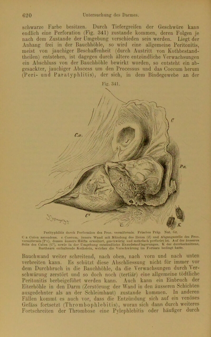 schwarze Farbe besitzen. Durch Tiefergreifen der Geschwüre kann endlich eine Perforation (Fig. 341) zustande kommen, deren Folgen je nach dem Zustande der Umgebung verschieden sein werden. Liegt der Anhang frei in der Bauchhöhle, so wird eine allgemeine Peritonitis, meist von jauchiger Beschaffenheit (durch Austritt von Kothbcstand- theilen) entstehen, ist dagegen durch ältere entzündliche Verwachsungen ein Abschluss von der Bauchhöhle bewirkt worden, so entsteht ein ab- gesackter, jauchiger Abscess um den Processus und das Coecum herum (Peri- und Paratyphlitis), der sich, in dem Bindegewebe an der Fig. 341. Perityphlitis durch Perforation des Proc. vermiformis. Frisches Prfip. Hat. (Ir. C a Colon aseendens. c Coecum, innere Wand mit Mündung de« lleuni (J) und Abgangsstelle des Proc. vermiformis (Pt), dessen äussere Hälfte erweitert, geschwiirig und mehrfach perforirt ist. Auf der äusseren Seite des Colon (C‘), sowie in der Umgebung entzündliche Exsudatauflagerungen. K der durchschnittene, llartliaare enthaltende Kothstein, welcher die Verschwärung int Fortsatz bedingt iiatte. Bauchwand weiter schreitend, nach oben, nach vorn und nach unten verbreiten kann. Es schützt diese Abschliessung nicht für immer vor dem Durchbruch in die Bauchhöhle, da die Verwachsungen durch A er- schwärung zerstört und so doch noch (tertiär) eine allgemeine tödtliche Peritonitis berbeigeführt werden kann. Auch kann ein Einbruch der Eiterhöhle in den Darm (Zerstörung der Wand in den äusseren Schichten ausgedehnter als an der Schleimhaut) zustande kommen. In anderen Fällen kommt es auch vor, dass die Entzündung sich auf ein venöses Gefäss fortsetzt (Thrombophlebitis), woran sich dann durch weiteres Fortschreiten der Thrombose eine Pylephlebitis oder häufiger durch