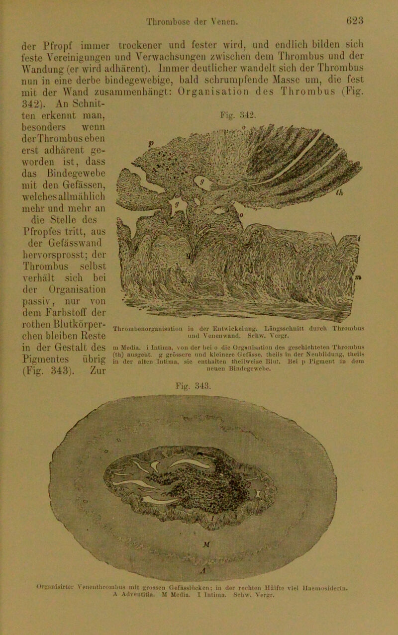 der Pfropf immer trockener und fester wird, und endlich bilden sich feste Vereinigungen und Verwachsungen zwischen dem Thrombus und der Wandung (er wird adhörent). Immer deutlicher wandelt sich der Thrombus nun in eine derbe bindegewebige, bald schrumpfende Masse um, die fest des Thrombus (Fig. mit der Wand zusammenhängt: 342). An Schnit- ten erkennt man, besonders wenn derThrombuseben erst ad hären t ge- worden ist, dass das Bindegewebe mit den Gefässen, welches allmählich mehr und mehr an die Stelle des Pfropfes tritt, aus der Gefässwand hervorsprosst; der Thrombus selbst verhält sich bei der Organisation passiv, nur von dem Farbstoff der rothen Blutkörper- chen bleiben Reste in der Gestalt des Pigmentes übrig (Fig. 343). Zur Organisation Fig. 342. Thrombenorganisation in der Entnickelung. Längsschnitt durch Thrombus und Venenwand. Sehw. Vcrgr. in Media, i Intima, von der hei o die Organisation des geschichteten Thrombus (th) ausgeht, g grossere und kleinere Gefässe, tlieils in der Neubildung, theils in der alten Intima, sie enthalten theihveise Blut. Bei p Pigment in dem neuen Bindegewebe. Fig. 343. Organiairter \ encnthroinbus mit grossen Gefässltickcn; in der rechten Hälfte viel Haemosiderin. A Adventitia. M Media. I Intima. 8ch\v. Yergr.