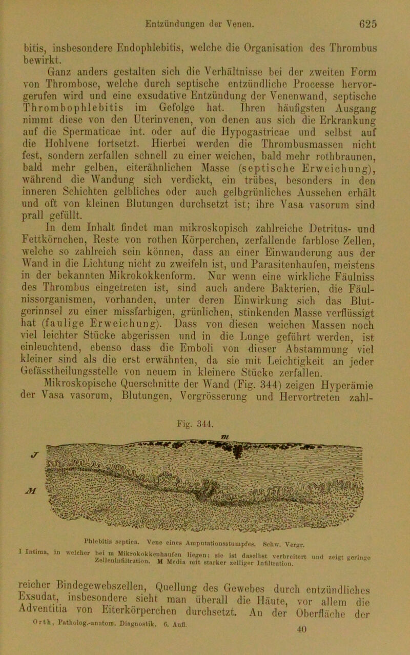 bitis, insbesondere Endophlebitis, welche die Organisation des Thrombus bewirkt. Ganz anders gestalten sich die Verhältnisse bei der zweiten Form von Thrombose, welche durch septische entzündliche Processe hervor- gerufen wird und eine exsudative Entzündung der Venenwand, septische Thrombophlebitis im Gefolge hat. Ihren häufigsten Ausgang nimmt diese von den Uterinvenen, von denen aus sich die Erkrankung auf die Spermaticae int. oder auf die Hypogastricae und selbst auf die Hohlvene lortsetzt. Hierbei werden die Thrombusmassen nicht fest, sondern zerfallen schnell zu einer weichen, bald mehr rothbraunen, bald mehr gelben, eiterähnlichen Masse (septische Erweichung), während die Wandung sich verdickt, ein trübes, besonders in den inneren Schichten gelbliches oder auch gelbgrünliches Aussehen erhält und oft von kleinen Blutungen durchsetzt ist; ihre Vasa vasorum sind prall gefüllt. In dem Inhalt findet man mikroskopisch zahlreiche Detritus- und Fettkörnchen, Reste von rothen Körperchen, zerfallende farblose Zellen, welche so zahlreich sein können, dass an einer Einwanderung aus der Wand in die Lichtung nicht zu zweifeln ist, und Parasitenhaufen, meistens in der bekannten Mikrokokken form. Nur wenn eine wirkliche Fäulniss des Thrombus eingetreten ist, sind auch andere Bakterien, die Fäul- nissorganismen, vorhanden, unter deren Einwirkung sich das Blut- gerinnsel zu einer missfarbigen, grünlichen, stinkenden Masse verflüssigt hat (faulige Erweichung). Dass von diesen weichen Massen noch viel leichter Stücke abgerissen und in die Lunge geführt werden, ist einleuchtend, ebenso dass die Emboli von dieser Abstammung viel kleiner sind als die erst erwähnten, da sie mit Leichtigkeit an jeder Gefässtheilungsstelle von neuem in kleinere Stücke zerfallen. Mikroskopische Querschnitte der Wand (Fig. 344) zeigen Hyperämie der Vasa vasorum, Blutungen, Vcrgrösserung und Hervortreten zahl- Fig. 344. Phlebitis septica. Veno eines Amputationsstumpfes. Sclnv. Vergr. I Intima, in welcher hei m Mikrokokkenhaufon liegen; sic ist daseihst verbreitert «nd /elleinnnltration. M Media mit starker zelliger Infiltration. zeigt geringe reicher Lindegewebszellen, Quellung des Gewebes durch entzündliches Exsudat, insbesondere sieht man überall die Häute, vor allem die Adventitia von Eiterkörperchen durchsetzt. An der Oberfläche der Orth, I’atholog.-anatoni. Diagnostik. 0. Aufl. 40