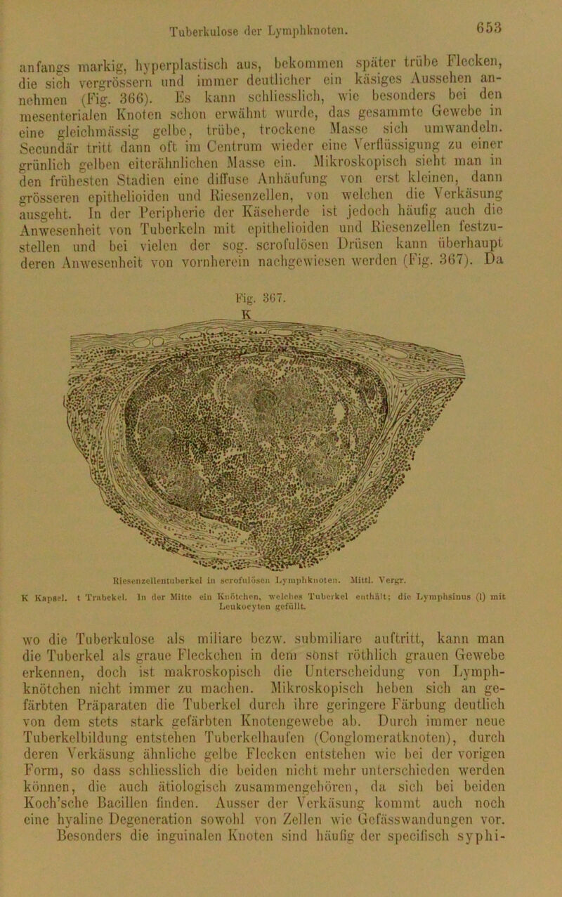 anfangs markig, hyperplastisch aus, bekommen später trübe Flecken, die sich vergrössern und immer deutlicher ein käsiges Aussehen an- nchmcn (Fig. 366). Ls kann schliesslich, wie besonders bei den mesenterialen Knoten schon erwähnt wurde, das gesummte Gewebe in eine gleichmässig gelbe, trübe, trockene Masse sich um wandeln. Secundär tritt dann oft im Centrum wieder eine \ erfiüssigung zu einer grünlich gelben eiterähnlichen Masse ein. Mikroskopisch sieht man in den frühesten Stadien eine diffuse Anhäufung von erst kleinen, dann grösseren epithelioiden und Riesenzellen, von welchen die Verkäsung ausgeht. In der Peripherie der Käseherde ist jedoch häufig auch die Anwesenheit von Tuberkeln mit epithelioiden und Riesenzellen testzu- stellen und bei vielen der sog. scrofulösen Drüsen kann überhaupt deren Anwesenheit von vornherein nachgewiesen werden (Fig. 367). Da Fig. 3G7. Riosenzellentnberkel in serofuloscii Lymphknoten. Mittl. Yergr. K Kapsel, t Trabekel. In der Mitte ein Knötchen, welches Tuberkel enthält: die I.yniphsinus (1) mit Leukocyten gefüllt. wo die Tuberkulose als miliare bezw. submiliare auftritt, kann man die Tuberkel als graue Fleckchen in dem sonst röthlich grauen Gewebe erkennen, doch ist makroskopisch die Unterscheidung von Lymph- knötchen nicht immer zu machen. Mikroskopisch heben sich an ge- färbten Präparaten die Tuberkel durch ihre geringere Färbung deutlich von dem stets stark gefärbten Knotengewebe ab. Durch immer neue Tuberkelbildung entstehen Tubcrkelhaufen (Conglomeratknotcn), durch deren Verkäsung ähnliche gelbe Flecken entstehen wie bei der vorigen Form, so dass schliesslich die beiden nicht mehr unterschieden werden können, die auch ätiologisch zusammengehören, da sich bei beiden Koch’sche Bacillen finden. Ausser der Verkäsung kommt auch noch eine hyaline Degeneration sowohl von Zellen wie Gefässwandungen vor. Besonders die inguinalen Knoten sind häutig der specilisch syphi-