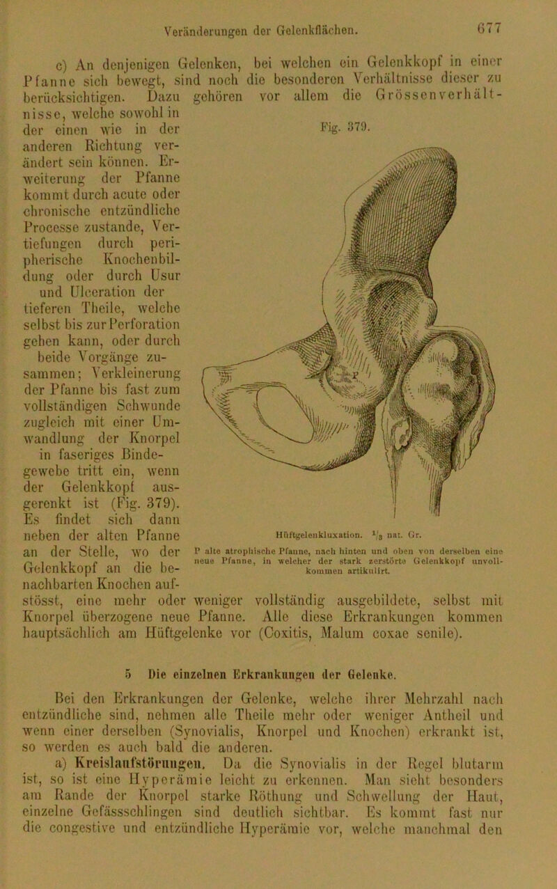 c) An denjenigen Pfanne sieh bewegt, Gelenken, bei welchen ein Gelenkkopf in einer sind noch die besonderen Verhältnisse dieser zu berücksichtigen. Dazu nisse, welche sowohl in der einen wie in der anderen Richtung ver- ändert sein können. Er- weiterung der Pfanne kommt durch acute oder ch roni sch c entzündliche Processe zustande, Ver- tiefungen durch peri- pherische Knochen bil- oder durch Usur und Ulceration der tieferen Theile, welche selbst bis zur Perforation gehen kann, oder durch beide Vorgänge zu- Verkleinerung gehören düng sammen der Pfanne bis fast zum Schwunde mit einer Um- wandlung der Knorpel in faseriges Binde- wenn aus- vollständigen zugleich vor allem die Grössen verhält- Fig. 379. gewebe tritt ein, der Gelenkkopl gerenkt ist (Fig. 379). Es findet sich dann neben der alten Pfanne an der Stelle, wo der Gelcnkkopf an die be- nachbarten Knochen auf- stösst, eine mehr oder Knorpel überzogene neue Pfanne. Hiiftgelenkluxation. 1'3 nat. Gr. P alte atrophische Pfanne, nach hinten und oben von derselben eine neue Pfanne, in welcher der stark zerstörte Gclenkkopf unvoll- kommen artikulirt. weniger vollständig ausgebildete, selbst mit Alle diese Erkrankungen kommen hauptsächlich am Hüftgelenke vor (Coxitis, Malum coxae senile). 5 Die einzelnen Erkrankungen der Gelenke. Bei den Erkrankungen der Gelenke, welche ihrer Mehrzahl nach entzündliche sind, nehmen alle Theile mehr oder weniger Antheil und wenn einer derselben (Synovialis, Knorpel und Knochen) erkrankt ist, so werden es auch bald die anderen. a) Kreislaufstörungen. Da die Synovialis in der Regel blutarm ist, so ist eine Hyperämie leicht zu erkennen. Man sieht besonders am Rande der Knorpel starke Röthung und Schwellung der Haut, einzelne Gcfässschlingen sind deutlich sichtbar. Es kommt fast nur die congestive und entzündliche Hyperämie vor, welche manchmal den