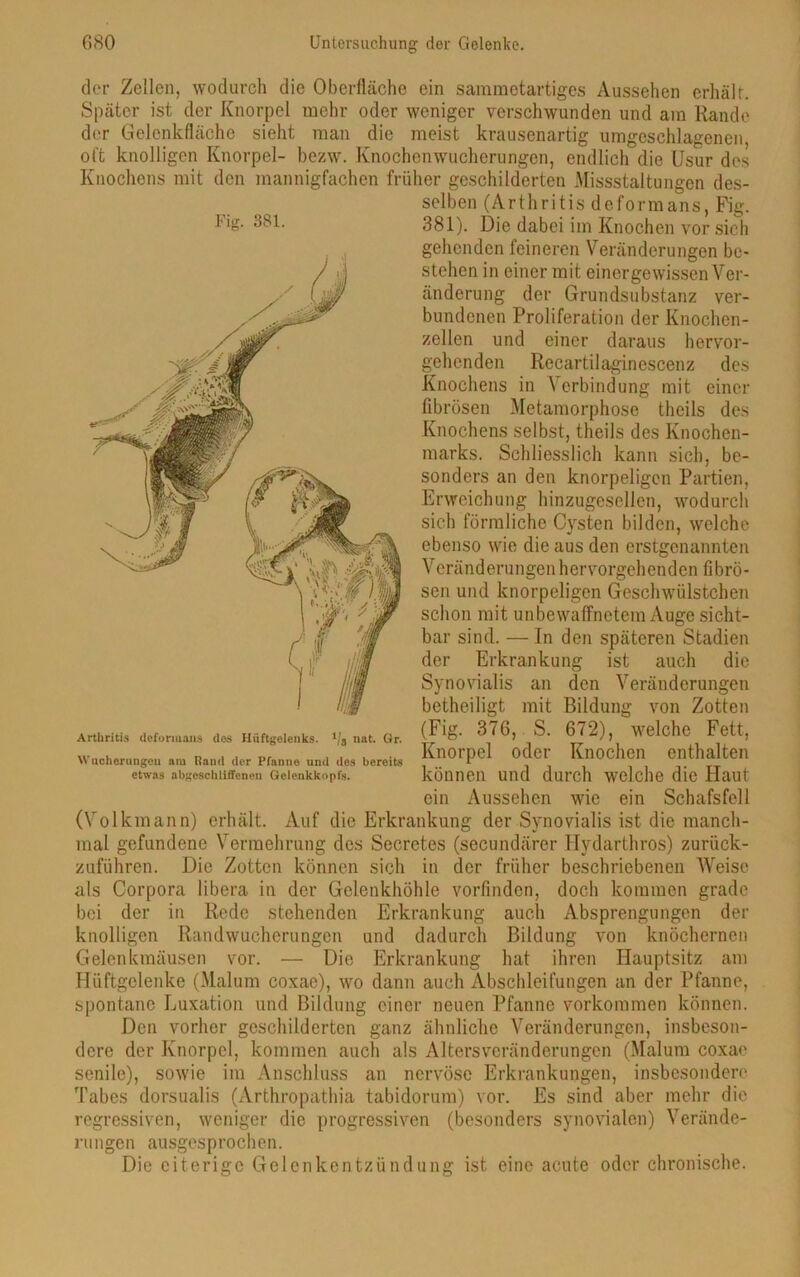 der Zellen, wodurch die Oberfläche ein sammetartiges Aussehen erhält. Später ist der Knorpel mehr oder weniger verschwunden und am Rande der Gelenkfläche sieht man die meist krausenartig umgeschlagenen oft knolligen Knorpel- bezw. Knochenwucherungen, endlich die Usur des Knochens mit den mannigfachen früher geschilderten .Missstaltungen des- selben (Arthritis de form ans, Fig. 381). Die dabei im Knochen vor sich gehenden feineren Veränderungen be- stehen in einer mit einergewissen Ver- änderung der Grundsubstanz ver- bundenen Proliferation der Knochen- zellen und einer daraus hervor- gehenden Recartilaginescenz des Knochens in Verbindung mit einer fibrösen Metamorphose thcils des Knochens selbst, tlieils des Knochen- marks. Schliesslich kann sich, be- sonders an den knorpeligen Partien, Erweichung hinzugesellen, wodurch sich förmliche Cysten bilden, welche ebenso wie die aus den erstgenannten Veränderungen hervorgehenden fibrö- sen und knorpeligen Geschwülstchen schon mit unbewaffnetem Auge sicht- bar sind. — In den späteren Stadien der Erkrankung ist auch die Synovialis an den Veränderungen betheiligt mit Bildung von Zotten (Fig. 376, S. 672), welche Fett, Knorpel oder Knochen enthalten können und durch welche die Haut ein Aussehen wie ein Schafsfell (Volkmann) erhält. Auf die Erkrankung der Synovialis ist die manch- mal gefundene Vermehrung des Secretes (secundärer Hydarthros) zurück- zuführen. Die Zotten können sich in der früher beschriebenen AVeise als Corpora libera in der Gelenkhöhle vorfinden, doch kommen grade bei der in Rede stehenden Erkrankung auch Absprengungen der knolligen Randwucherungen und dadurch Bildung von knöchernen Gelenkmäusen vor. — Die Erkrankung hat ihren Hauptsitz am Hüftgelenke (Malum coxae), wo dann auch Abschleifungen an der Pfanne, spontane Luxation und Bildung einer neuen Pfanne Vorkommen können. Den vorher geschilderten ganz ähnliche Veränderungen, insbeson- dere der Knorpel, kommen auch als Altersveränderungen (Malum coxae senile), sowie im Anschluss an nervöse Erkrankungen, insbesondere Tabes dorsualis (Arthropathia tabidorum) vor. Es sind aber mehr die regressiven, weniger die progressiven (besonders synovialen) Verände- rungen ausgesprochen. Die eiterige Gelenkentzündung ist eine acute oder chronische. Fig. 381. 'M-X 0.:-.K?v,x Arthritis deformans des Hüftgelenks. 1/a nat. Gr. Wucherungen am Rand der Pfanne und des bereits etwas abgeschliffenen Gelenkkopfs.