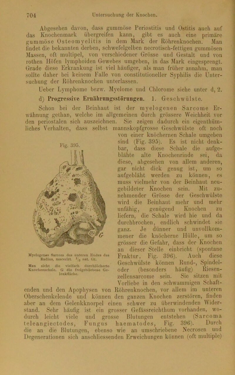 Abgesehen davon, dass gummöse Periostitis und Ostitis aucli auf das Knochenmark übergreifen kann, gibt es auch eine primäre gummöse Osteomyelitis in dem Mark der Röhrenknochen. Man findet die bekannten derben, schwefelgelben necrotisch-fettigen gummösen Massen, oft multipel, von verschiedener Grösse und Gestalt und von rothen Höfen lymphoiden Gewebes umgeben, in das Mark eingesprengt. Grade diese Erkrankung ist viel häufiger, als man früher annahm, man sollte daher bei keinem Falle von constitutioneller Syphilis die Unter- suchung der Röhrenknochen unterlassen. Uebcr Lymphome bezw. Myelome und Chlorome siehe unter d, 2. d) Progressive Ernährungsstörungen. 1. Geschwülste. Schon bei der Beinhaut ist der myelogenen Sarcorae Er- wähnung gethan, welche im allgemeinen durch grössere Weichheit vor den periostalen sich auszeichnen. Sie zeigen dadurch ein eigen thüm- liches Verhalten, dass selbst mannskopfgrosse Geschwülste oft noch von einer knöchernen Schale umgeben sind (Fig. 395). Es ist nicht denk- bar, dass diese Schale die aufge- blähte alte Knochenrinde sei, da diese, abgesehen von allem anderen, gar nicht dick genug ist, um so aufgebläht werden zu können, es muss vielmehr von der Beinhaut neu- gebildeter Knochen sein. Mit zu- nehmender Grösse der Geschwülste wird die Beinhaut mehr und mehr unfähig, genügend Knochen zu liefern, die Schale wird hie und da durchbrochen, endlich schwindet sic ganz. Je dünner und unvollkom- mener die knöcherne Hülle, um so grösser die Gefahr, dass der Knochen an dieser Stelle einbricht (spontane Fraktur, Fig. 396). Auch diese Geschwülste können Rund-, Spindel- oder (besonders häufig) Riesen- zellensarcome sein. Sie sitzen mit Vorliebe in den schwammigen Schaft- enden und den Apophysen von Röhrenknochen, vor allem im unteren Oberschenkelende und können den ganzen Knochen zerstören, linden aber an dem Gelenkknorpel einen schwer zu überwindenden Wider- stand. Sehr häufig ist ein grosser Gefässreichthum vorhanden, wo- durch leicht viele und grosse Blutungen entstehen (Sarcoma teleangiectodes, Fungus haematodes, Fig. 396). Durch die an die Blutungen, ebenso wie an umschriebene Necroscn und Degenerationen sich anschliessenden Erweichungen können (oft multiple) Fig. 395. Myelogenes Sarcom des unteren Endes des ltadius, macerirt. 1/3 nat. Gr. Man sieht die vielfach durchlöcherte Knochenschale. G die freigebliebeue Ge- lenkfläche.