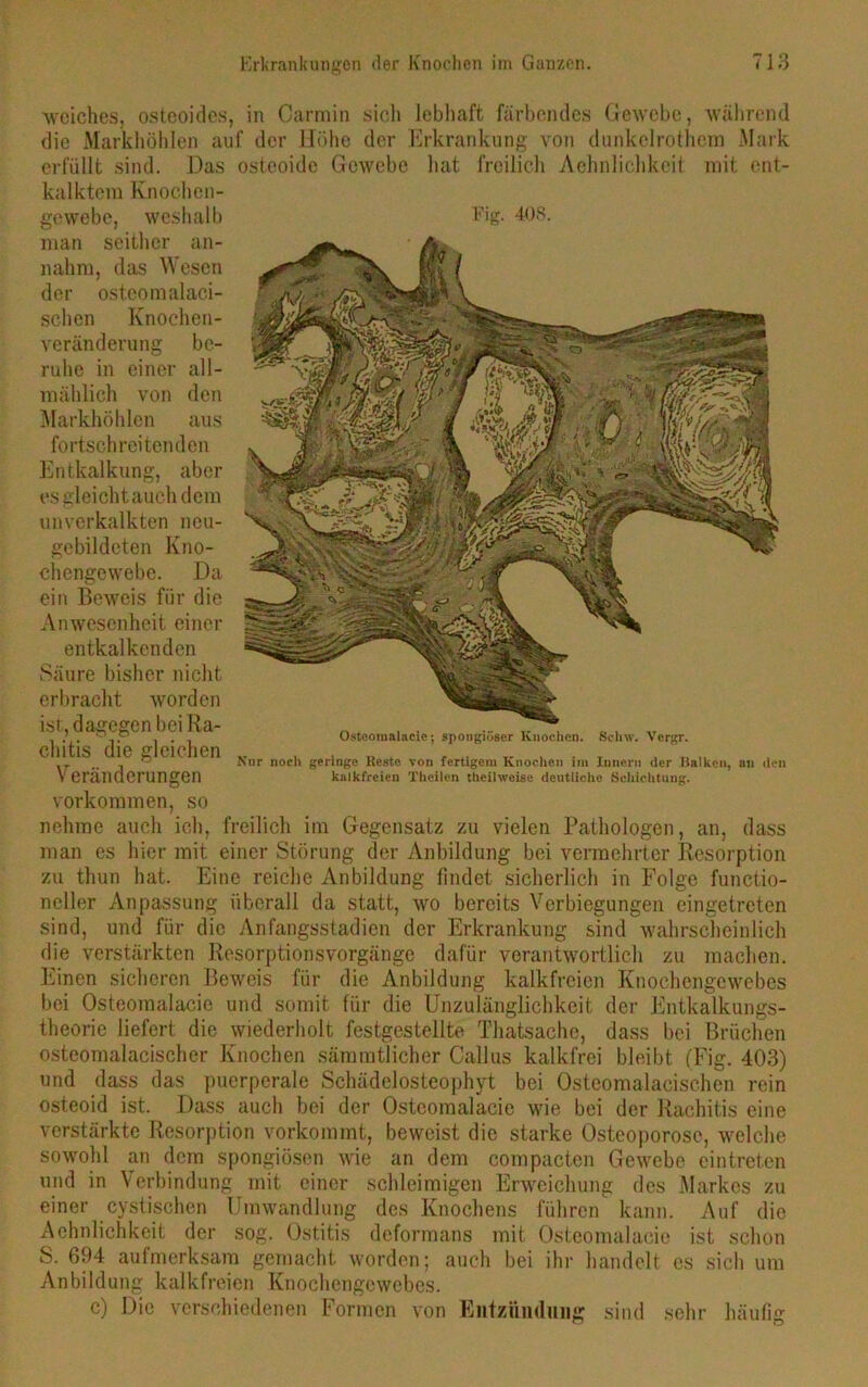 weiches, osteoides, in Carmin sich lebhaft färbendes Gewebe, während die Markhöhlen auf der Höhe der Erkrankung von dunkclrothem Mark erfüllt sind. Das osteoide Gewebe hat freilich Achnlichkeit mit ent- kalktem Knochen- gewebe, weshalb man seither an- nahm, das Wesen der ost.com alaci- schen Knochen- veränderung be- ruhe in einer all- mählich von den Markhöhlen aus fortschreitenden Entkalkung, aber es gleicht auch dem unverkalkten neu- gebildeten Kno- chengewebe. Da ein Beweis für die Anwesenheit einer entkalkenden Säure bisher nicht erbracht worden ist, dagegen bei Ra- chitis die gleichen Veränderungen Fig. 408. Nur noch geringe Reste von fertigem Knochen im Innern der Balken, an den kalkfreien Theilen t heil weise deutliche Schichtung. Osteomalacie; spongiöser Knochen. Sc luv. Vergr. Vorkommen, so nehme auch ich, freilich im Gegensatz zu vielen Pathologen, an, dass man es hier mit einer Störung der Anbildung bei vermehrter Resorption zu thun hat. Eine reiche Anbildung findet sicherlich in Folge functio- neller Anpassung überall da statt, wo bereits Verbiegungen eingetreten sind, und für die Anfangsstadien der Erkrankung sind wahrscheinlich die verstärkten Resorptionsvorgänge dafür verantwortlich zu machen. Einen sicheren Beweis für die Anbildung kalkfreien Knochengewebes bei Osteomalacie und somit für die Unzulänglichkeit der Entkalkungs- theorie liefert die wiederholt festgestellte Thatsache, dass bei Brüchen osteomalacischer Knochen sämmtlicher Callus kalkfrei bleibt (Fig. 403) und dass das puerperale Schädelosteophyt bei Osteomalacischen rein osteoid ist. Dass auch bei der Osteomalacie wie bei der Rachitis eine verstärkte Resorption vorkommt, beweist die starke Osteoporose, welche sowohl an dem spongiösen wie an dem compacten Gewebe eintreten und in Verbindung mit einer schleimigen Erweichung des Markes zu einer cystischen Umwandlung des Knochens führen kann. Auf die Achnlichkeit der sog. Ostitis deformans mit Osteomalacie ist schon S. 694 aufmerksam gemacht worden; auch bei ihr handelt es sich um Anbildung kalkfreien Knochengewebes. c) Die verschiedenen Formen von Entzündung sind sehr häufig