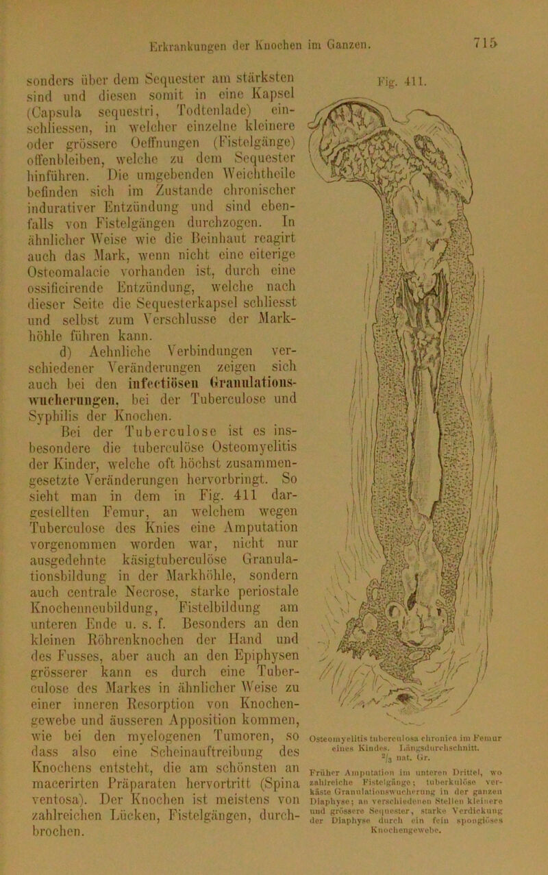 sonders über dem Sequester am stärksten sind und diesen somit in eine Kapsel (Capsula sequestri, Todtenlade) ein- sehliessen, in welcher einzelne kleinere oder grössere Oeffnungen (Fistelgänge) offenbleiben, welche zu dein Sequester hinführen. Die umgebenden Weichtheile befinden sieh im Zustande chronischer indurativer Entzündung und sind eben- falls von Fistelgängen durchzogen. In ähnlicher Weise wie die Beinhaut rcagirt auch das Mark, wenn nicht eine eiterige Osteomalacie vorhanden ist, durch eine ossificirendc Entzündung, welche nach dieser Seite die Sequesterkapsel schliesst und selbst zum Verschlüsse der Mark- höhle führen kann. d) Aehnliehe Verbindungen ver- schiedener Veränderungen zeigen sich auch hei den infectiösen Granulations- Wucherungen. bei der Tuberculose und Syphilis der Knochen. Bei der Tuberculose ist cs ins- besondere die tuberculose Osteomyelitis der Kinder, welche oft höchst zusammen- gesetzte Veränderungen hervorbringt. So sieht man in dem in Fig. 411 dar- gestellten Femur, an welchem wegen Tuberculose des Knies eine Amputation vorgenommen worden war, nicht nur ausgedehnte käsigtubereulöse Granula- tionsbildung in der Markhöhle, sondern auch centrale Necrose, starke periostale Knochenneubildung, Fistelbildung am unteren Ende u. s. f. Besonders an den kleinen Röhrenknochen der Hand und des Fusses, aber auch an den Epiphysen grösserer kann es durch eine Tuber- culose des Markes in ähnlicher Weise zu einer inneren Resorption von Knochen- gewebe und äusseren Apposition kommen, wie bei den myelogenen Tumoren, so dass also eine Scheinauftreibung des Knochens entsteht, die am schönsten an macerirten Präparaten hervortritt (Spina ventosa). Der Knochen ist meistens von zahlreichen Lücken, Fistelgängen, durch- brochen. Fig. 411. *■ v «j AIAte ■ i; mß Mi V \l ' “ Osteomyelitis tiibcrcuiosa chronica im Femur eines Kindes. J/ängsdurclisehimt. 2/3 nat. Gr. Früher Amputation im unteren Drittel, wo zahlreiche FistclgSnge; tuberkulöse ver- käste Granu lat ionswuchc rung in der ganzen Diapliyso; an verschiedenen Stellen kleinere und grössere Sequester, starke Verdickung der Diaphyso durch ein fein spongiöses Knocliengewche.