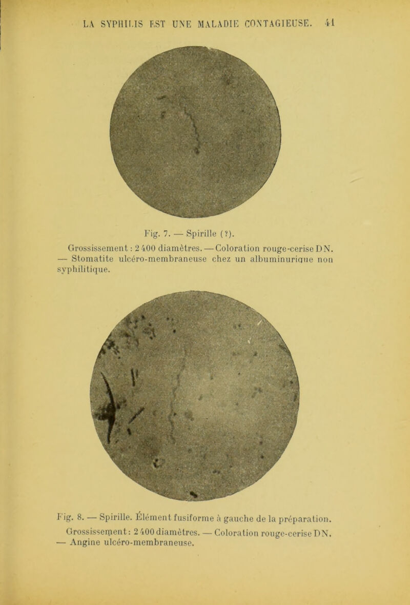 Fig. 7. — Spirille (?). Grossissement: 2 400 diamètres. — Coloration rouge-ceriseDN. — Stomatite ulcéro-membraneuse chez un albuminurique non syphilitique. F ig. 8. — Spirille. Élément fusiforme à gauche de la préparatio n. Grossissement: 2 400 diamètres. — Coloration rouge-cerise DN. — Angine ulcéro-membraneuse.