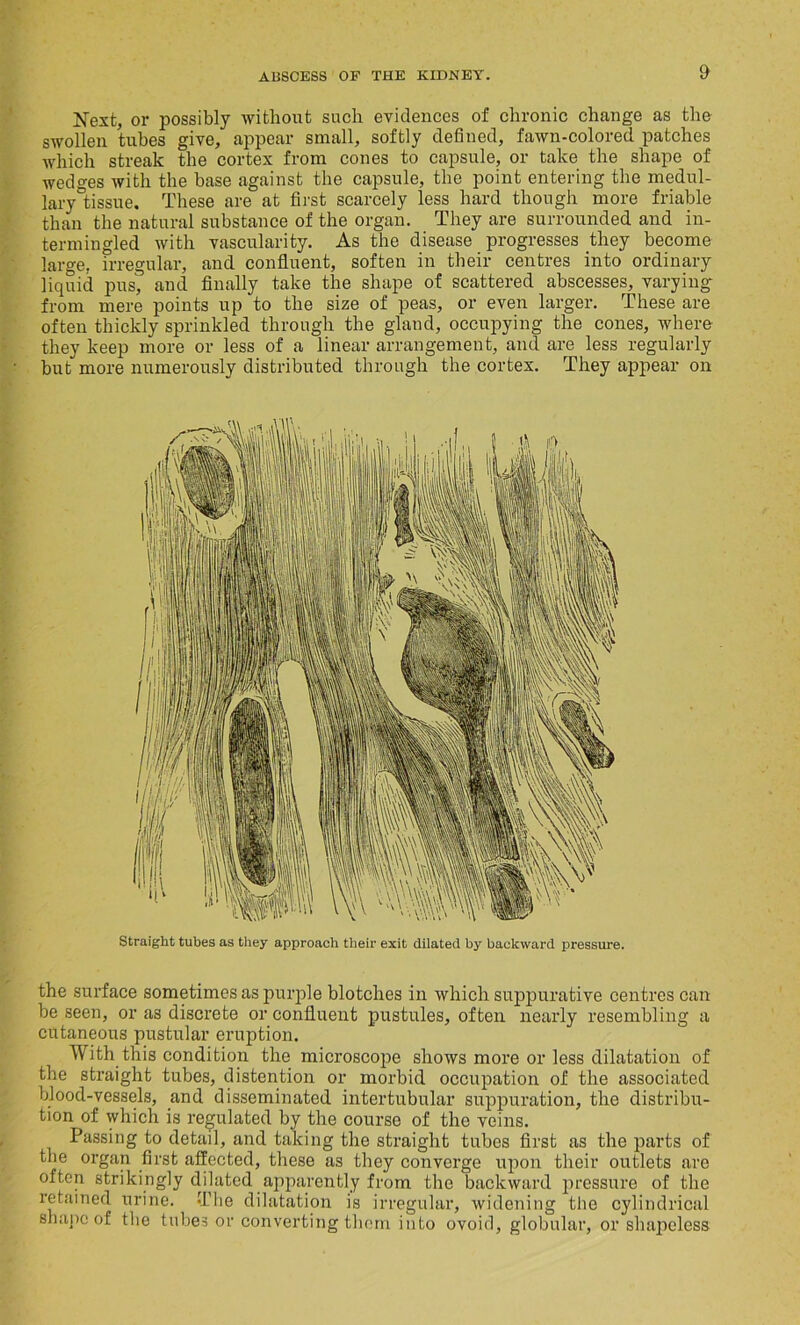 Next, or possibly without such evidences of chronic change as the swollen tubes give, appear small, softly defined, fawn-colored patches which streak the cortex from cones to capsule, or take the shape of wedges with the base against the capsule, the point entering the medul- lary °tissue. These are at first scarcely less hard though more friable than the natural substance of the organ. They are surrounded and in- termingled with vascularity. As the disease progresses they become large, irregular, and confluent, soften in their centres into ordinary liquid pus, and finally take the shape of scattered abscesses, varying from mere points up to the size of peas, or even larger. These are often thickly sprinkled through the gland, occupying the cones, where they keep more or less of a linear arrangement, and are less regularly but more numerously distributed through the cortex. They appear on Straight tubes as they approach their exit dilated by backward pressure. the surface sometimes as purple blotches in which suppurative centres can be seen, or as discrete or confluent pustules, often nearly resembling a cutaneous pustular eruption. With this condition the microscope shows more or less dilatation of the straight tubes, distention or morbid occupation of the associated blood-vessels, and disseminated intertubular suppuration, the distribu- tion of which is regulated by the course of the veins. Passing to detail, and taking the straight tubes first as the parts of the organ first affected, these as they converge upon their outlets are often strikingly diluted apparently from the backward pressure of the retained urine. The dilatation is irregular, widening the cylindrical shape of the tubes or converting them into ovoid, globular, or shapeless