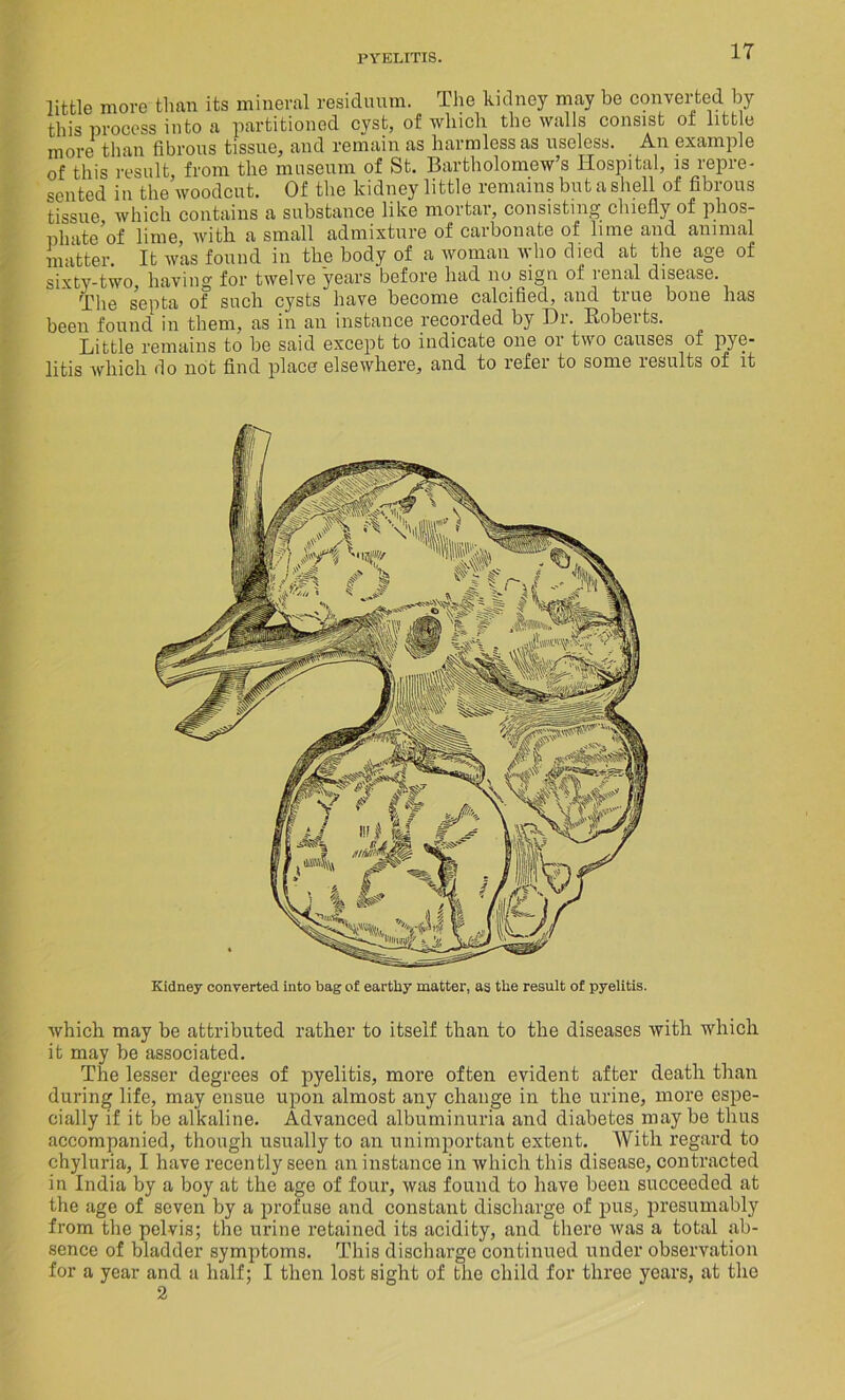 little move than its mineral residuum. The kidney may be converted by this process into a partitioned cyst, of which the walls consist ot little more than fibrous tissue, and remain as harmless as useless. An example of this result from the museum of St. Bartholomew’s Hospital, is repre- sented in the woodcut. Of the kidney little remains but a shell of fibrous tissue which contains a substance like mortar, consisting chiefly of plios- phate’of lime, with a small admixture of carbonate of lime and animal matter. It was found in the body of a woman who died at the age of sixty-two, having for twelve years before had no sign of lenal disease. The septa of such cysts have become calcified, and true bone has been found in them, as in an instance recoided by Hi. Robeits. Little remains to be said except to indicate one or two causes of pye- litis which do not find place elsewhere, and to refer to some results of it Kidney converted into bag of earthy matter, as the result of pyelitis. which may be attributed rather to itself than to the diseases with which it may be associated. The lesser degrees of pyelitis, more often evident after death than during life, may ensue upon almost any change in the urine, more espe- cially if it lie alkaline. Advanced albuminuria and diabetes may be thus accompanied, though usually to an unimportant extent. With regard to chyluria, I have recently seen an instance in which this disease, contracted in India by a boy at the age of four, was found to have been succeeded at the age of seven by a profuse and constant discharge of pus, presumably from the pelvis; the urine retained its acidity, and there was a total ab- sence of bladder symptoms. This discharge continued under observation for a year and a half; I then lost sight of the child for three years, at the 2