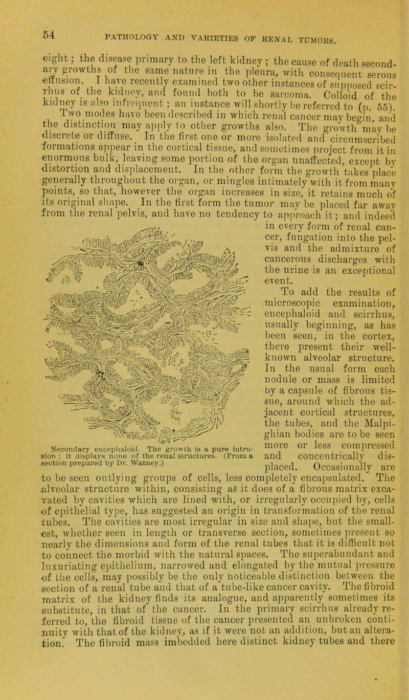 &‘*u ’ disease primary to the left kidney ; the cause of death second- eight ary growths of the samenature in the pleura, with consequent serous effusion. I have recently examined two other instances of supposed scir- rhus of the kidney, and found both to he sarcoma. Colloid of the kidney is also infrequent ; an instance will shortly he referred to (p. 55) Two modes have been described in which renal cancer may begin and the distinction may apply to other growths also. The growth may be discrete or diffuse. In the first one or more isolated and circumscribed formations appear in the cortical tissue, and sometimes project from it in enormous bulk, leaving some portion of the organ unaffected, except by distortion and displacement. In the other form the growth takes place generally throughout the organ, or mingles intimately with it from many points, so that, however the organ increases in size, it retains much of its original shape. In the first form the tumor may be placed far away from the renal pelvis, and have no tendency to approach it; and indeed in every form of renal can- r ■> jwSsl, cer, fungation into the pel- vis and the admixture of cancerous discharges with the urine is an exceptional event. To add the results of microscopic examination, encephaloid and scirrhus, usually beginning, as has been seen, in the cortex, there present their well- known alveolar structure. In the usual form each nodule or mass is limited by a capsule of fibrous tis- sue, around which the ad- jacent cortical structures, the tubes, and the Malpi- ghian bodies are to be seen more or less compressed and concentrically dis- placed. Occasionally are to be seen outlying groups of cells, less completely encapsulated. The alveolar structure within, consisting as it does of a fibrous matrix exca- vated by cavities which are lined with, or irregularly occupied by, cells of epithelial type, has suggested an origin in transformation of the renal tubes. The cavities are most irregular in size and shape, but the small- est, whether seen in length or transverse section, sometimes present so nearly the dimensions and form of the renal tubes that it is difficult not to connect the morbid with the natural spaces. The superabundant and luxuriating epithelium, narrowed and elongated by the mutual pressure •of the cells, may possibly be the only noticeable distinction between the section of a renal tube and that of a tube-like cancer cavity. The fibroid matrix of the kidney finds its analogue, and apparently sometimes its substitute, in that of the cancer. In the primary scirrhus already re- ferred to, the fibroid tissue of the cancer presented an unbroken conti- nuity with that of the kidney, as if it were not an addition, but an altera- tion. The fibroid mass imbedded here distinct kidney tubes and there Secondary encephaloid. The growth is a pure intru- sion ; it displays none of the renal structures. (From a section prepared by Dr. Watney.)