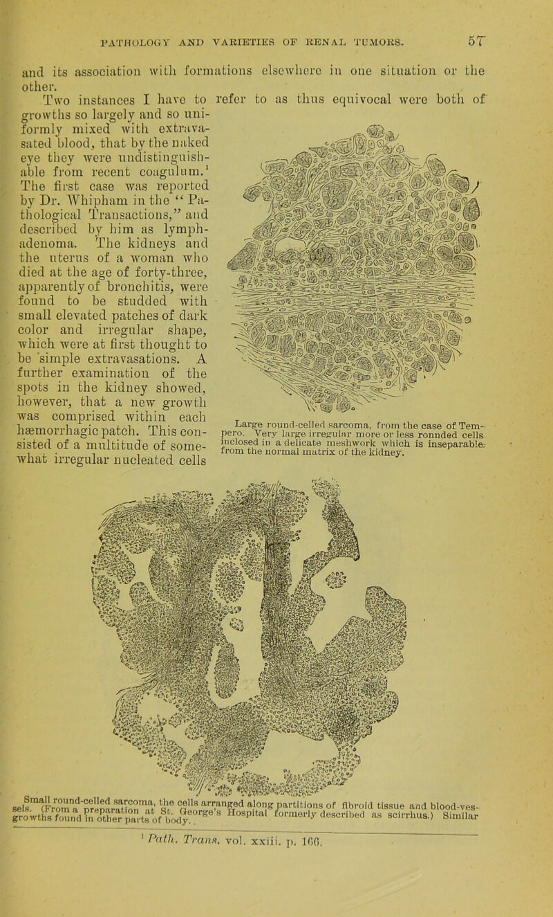 and its association with formations elsewhere in one situation or the other. Two instances I have to refer to as thus equivocal were both of growths so largely and so uni- formly mixed with extrava- sated blood, that by the naked eye they were undistinguish- able from recent coagulum.1 The first case was reported by Dr. Whipham in the “ Pa- thological Transactions,” and described by him as lymph- adenoma. The kidneys and the uterus of a woman who died at the age of forty-three, apparently of bronchitis, were found to be studded with small elevated patches of dark color and irregular shape, which were at first thought to be simple extravasations. A further examination of the spots in the kidney showed, however, that a new growth was comprised within each hasmorrhagic patch. This con- sisted of a multitude of some- what irregular nucleated cells Large round-celled sarcoma, from the case of Tem- pero. Very large irregular more or less ronnded cells inclosed in a delicate meshwork which is inseparable^ from the normal matrix of the kidney. selsra^F^mn^nrenar^mnmTt’ o!® a8 arr,angred a.lotW partitions of fibroid tissue and blood-ves wth^fouifd Vn^he^jnuds oMjodye°r^e 8 &°aP‘tal *°rmeI’1Y described as scirrhus.) Simila