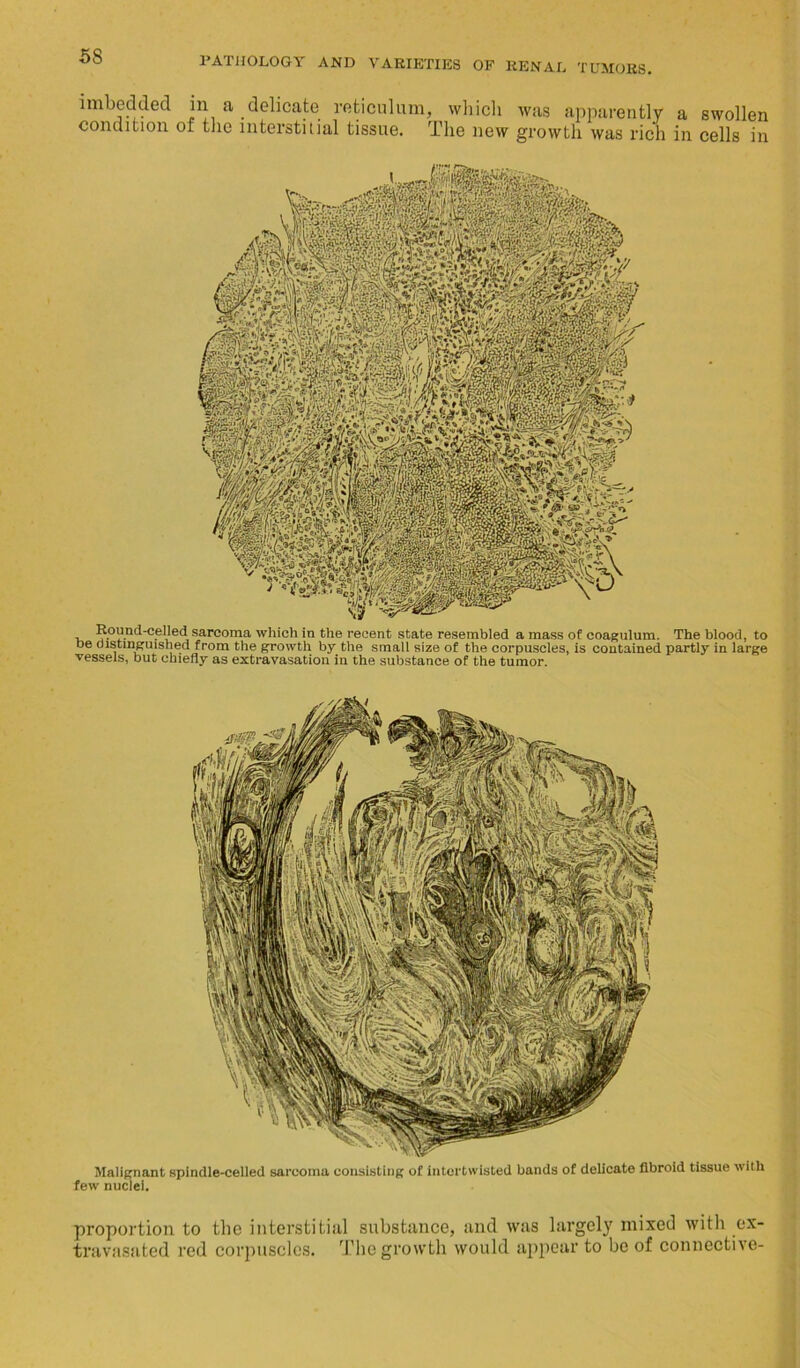 imbedded in a delicate reticulum, which was apparently a swollen condition of the interstitial tissue. The new growth was rich in cells in , Kound-cellcd sarcoma which in the recent state resembled a mass of coagulum. The blood, to be distinguished from the growth by the small size of the corpuscles, is contained partly in large vessels, but chiefly as extravasation in the substance of the tumor. Malignant spindle-celled sarcoma consisting of intertwisted bands of delicate fibroid tissue with few nuclei. proportion to the interstitial substance, and was largely mixed with ex- travasated red corpuscles. The growth would appear to be of connective-