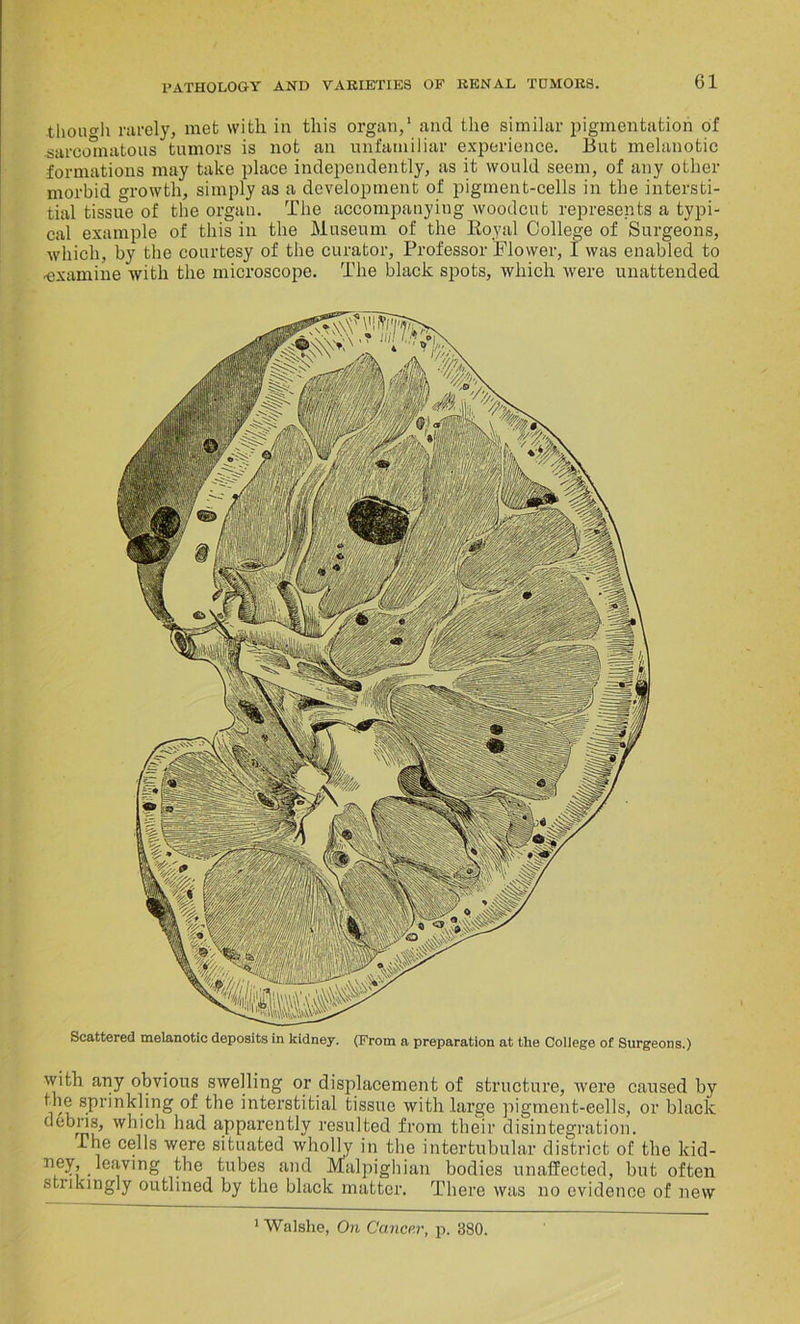 though rarely, met with in this organ/ and the similar pigmentation of .sarcomatous tumors is not an unfamiliar experience. But melanotic formations may take place independently, as it would seem, of any other morbid growth, simply as a development of pigment-cells in the intersti- tial tissue of the organ. The accompanying woodcut represents a typi- cal example of this in the Museum of the Royal College of Surgeons, which, by the courtesy of the curator, Professor Flower, I was enabled to ■examine with the microscope. The black spots, which were unattended Scattered melanotic deposits in kidney. (From a preparation at the College of Surgeons.) with any obvious swelling or displacement of structure, were caused by the sprinkling of the interstitial tissue with large pigment-eells, or black debris, which had apparently resulted from their disintegration. The cells were situated wholly in the intertubular district of the kid- ney, leaving the tubes and Malpighian bodies unaffected, but often strikingly outlined by the black matter. There was no evidence of new 1 Walshe, On Cancer, p. 380.