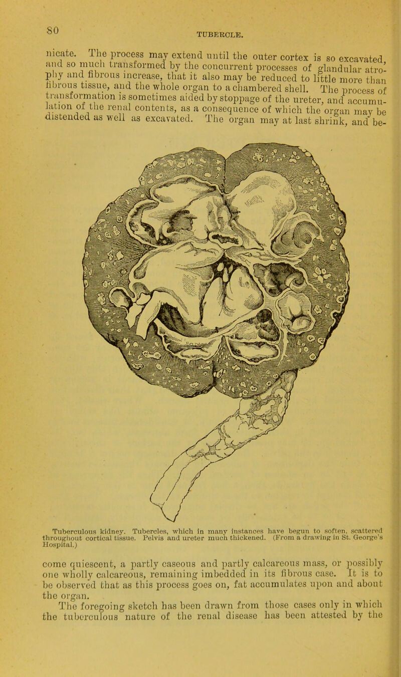 TUBERCLE. nicate. J lie process may extend until the outer cortex is so excavated and so much transformed by the concurrent processes of glandular atro- phy and fibrous increase, that it also may be reduced to little more than fibrous tissue, and the whole organ to a chambered shell. The process of transformation is sometimes aided by stoppage of the ureter, and accumu- fauon ot the renal contents, as a consequence of which the organ may be distended as well as excavated. The organ may at last shrink, and be- Tuberculous kidney. Tubercles, which in many instances have begun to soften, scattered throughout cortical tissue. Pelvis and ureter much thickened. (From a drawing in St. George’s Hospital.) come quiescent, a partly caseous and partly calcareous mass, or possibly one wholly calcareous, remaining imbedded in its fibrous case. It is to be observed that as this process goes on, fat accumulates upon and about the organ. The foregoing sketch has been drawn from those cases only in which the tuberculous nature of the renal disease has been attested by the