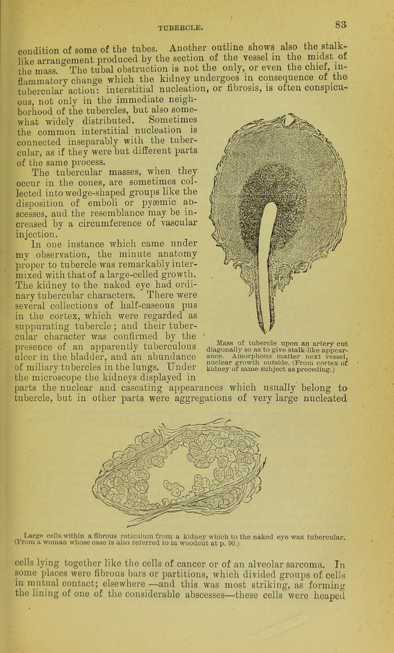 condition of some of the tubes. Another outline shows also the stalk- like arrangement produced by the section of the vessel m the midst of the mass The tubal obstruction is not the only, or even the chief, in- flammatory change which the kidney undergoes m consequence of the tubercular action: interstitial nucleation, or fibrosis, is often conspicu- ous, not only in the immediate neigh- borhood of the tubercles, but also some- what widely distributed. Sometimes the common interstitial nucleation is connected inseparably with the tuber- cular, as if they were but different parts of the same process. The tubercular masses, when they occur in the cones, are sometimes col- lected into wedge-shaped groups like the disposition of emboli or pysemic ab- scesses, and the resemblance may be in- creased by a circumference of vascular injection. In one instance which came under my observation, the minute anatomy proper to tubercle was remarkably inter- mixed with that of a large-celled growth. The kidney to the naked eye had ordi- nary tubercular characters. There were several collections of half-caseous pus in the cortex, which were regarded as suppurating tubercle ; and their tuber- cular character was confirmed by the presence of an apparently tuberculous ulcer in the bladder, and an abundance ance. Amorphous matter next vessel, 01 miliary tubercles ill the lungs. U ncler kidney of same subject as preceding.) the microscope the kidneys displayed in parts the nuclear and caseating appearances which usually belong to tubercle, but in other parts were aggregations of very large nucleated Large cells within a fibrous reticulum from a kidney which to the naked eye was tubercular. (From a woman whose case is also referred to iu woodcut at p. 90.) cells lying together like the cells of cancer or of an alveolar sarcoma. In some places were fibrous bars or partitions, which divided groups of cells in mutual contact; elsewhere —and this was most striking, as forming the lining of one of the considerable abscesses—these cells were heaped