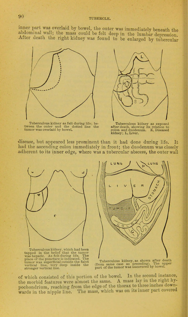 TUBERCLE. was overlaid by bowel, the outer was immediately beneath the wall; the mass could be felt deep in the lumbar After death the right kidney was found to be enlarged by depression. tubercular inner part abdominal tumor was overlaid by bowel. ■disease, but appeared less prominent than it had done during life. It had the ascending colon immediately in front; the duodenum was closely adherent to its inner edge, where was a tubercular abscess, the outer wall Tuberculous kidney, which had been tapped in the belief that the tumor was hepatic. As felt during life. The place of the puncture is indicated. The tumor was superficial outside the faint vertical line, very deep inside the stronger vertical line. of which consisted of this portion of the bowel. In the second instance, the morbid features were almost the same. A mass lay in the right liy- pochondrium, reaching from the edge of the thorax to three inches down- wards in the nipple line. The mass, which was on its inner part covered