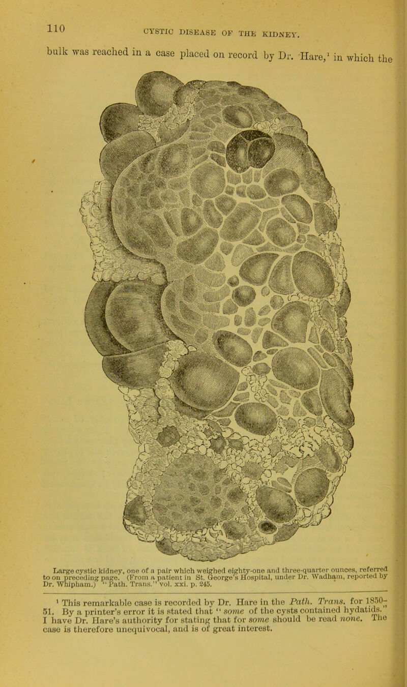 CYSTIC DISEASE OF THE KIDNEY bulk was reached in a case placed on record by Dr. Hare,* 1 in which the Large cystic kidney, one of a pair which weighed eighty-one and three-quarter ounces, referred to on preceding page. (From a patient in St. George’s Hospital, under Dr. Wadham, reported by Dr. Whipham.) “ Path. Trans. vol. xxi. p. 245. ’ This remarkable case is recorded by Dr. Hare in the Path. Trans, for 1850- 51. By a printer’s error it is stated that “ some of the cysts contained hydatids. I have Dr. Hare’s authority for stating that for some should be read none. The case is therefore unequivocal, and is of great interest. '