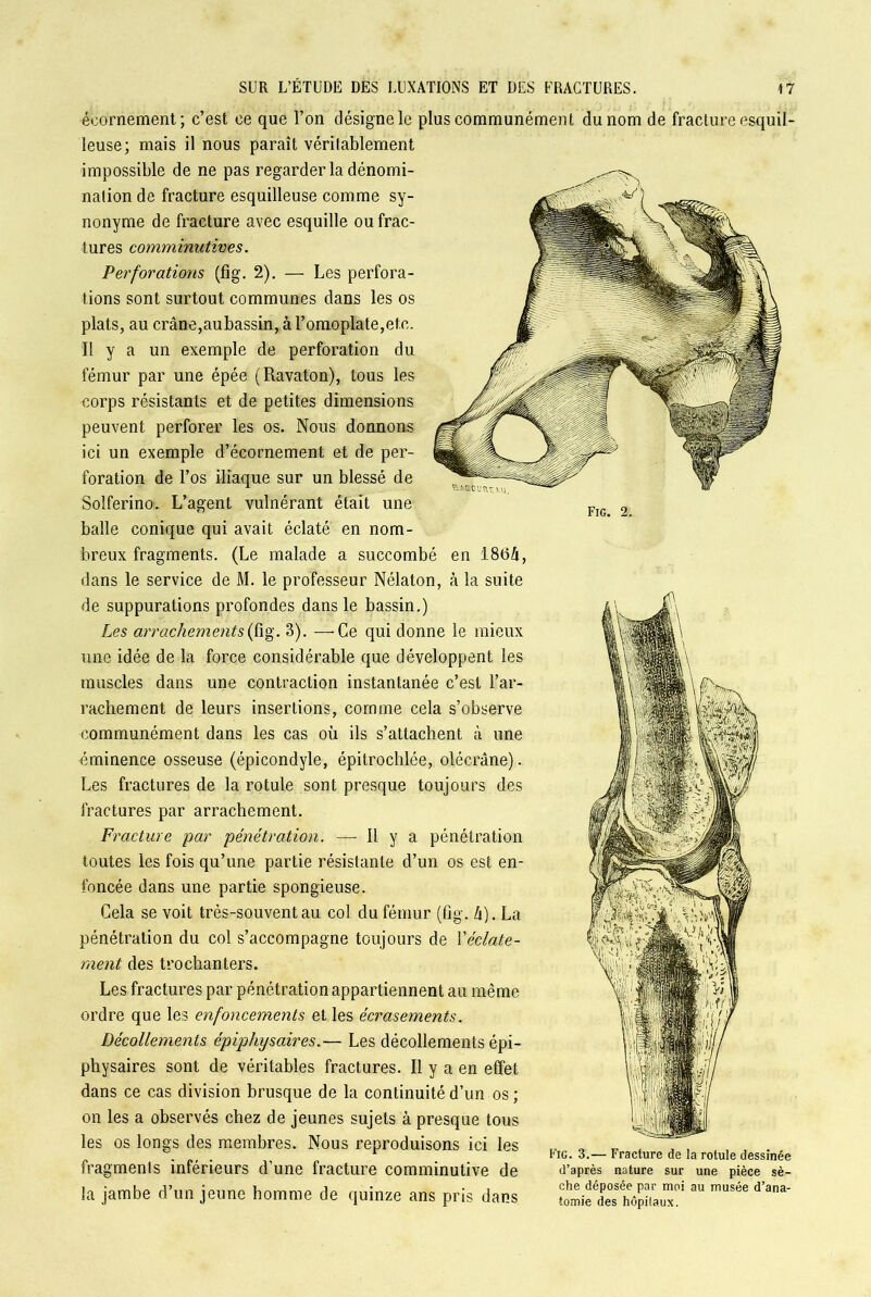 Fig. 2. écornement; c’est ce que l’on désigne le plus communément du nom de fracture esquil- leuse; mais il nous paraît véritablement impossible de ne pas regarder la dénomi- nation de fracture esquilleuse comme sy- nonyme de fracture avec esquille ou frac- tures comminutives. Perforations (fig. 2). — Les perfora- tions sont surtout communes dans les os plats, au crâne,aubassin, à l’omoplate,etc. Il y a un exemple de perforation du fémur par une épée (Ravaton), tous les corps résistants et de petites dimensions peuvent perforer les os. Nous donnons ici un exemple d’écornement et de per- foration de l’os iliaque sur un blessé de Solferino. L’agent vulnérant était une balle conique qui avait éclaté en nom- breux fragments. (Le malade a succombé en Î8(5â, dans le service de M. le professeur Nélaton, à la suite de suppurations profondes dans le bassin.) Les arrachements(fig. 3). —Ce qui donne le mieux une idée de la force considérable que développent les muscles dans une contraction instantanée c’est l’ar- rachement de leurs insertions, comme cela s’observe communément dans les cas où ils s’attachent à une éminence osseuse (épicondyle, épitrochlée, olécrane). Les fractures de la rotule sont presque toujours des fractures par arrachement. Fracture par pénétration. — H y a pénétration toutes les fois qu’une partie résistante d’un os est en- foncée dans une partie spongieuse. Cela se voit très-souvent au col du fémur (fig. h). La pénétration du col s’accompagne toujours de Y éclate- ment des trochanters. Les fractures par pénétration appartiennent au même ordre que les enfoncements et les écrasements. Décollements épiphysaires.— Les décollements épi- physaires sont de véritables fractures. Il y a en effet dans ce cas division brusque de la continuité d’un os ; on les a observés chez de jeunes sujets à presque tous les os longs des membres. Nous reproduisons ici les ,, 0 _ . . , . , , . fragments inférieurs d’une fracture comminutive de d’après nature sur une pièce sè- la jambe d'un jeune homme de quinze ans pris dans ^