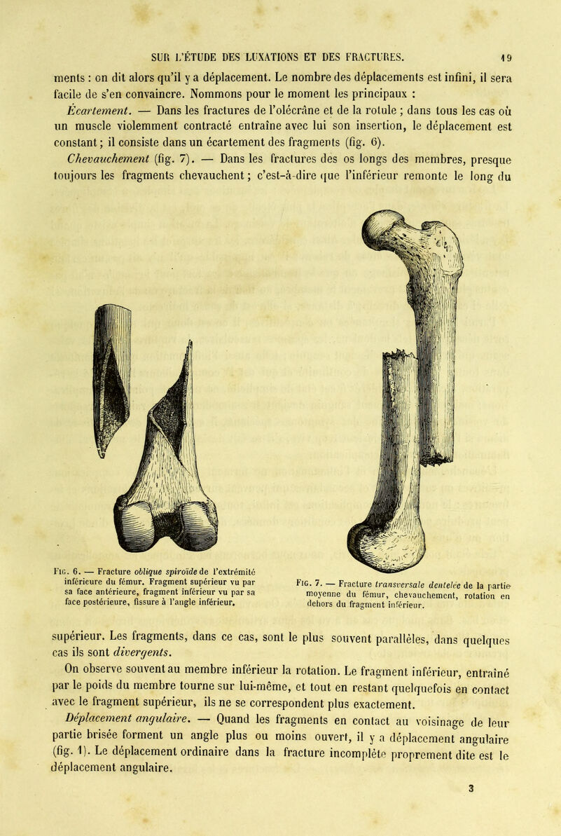 ments : on dit alors qu’il y a déplacement. Le nombre des déplacements est infini, il sera facile de s’en convaincre. Nommons pour le moment les principaux : Écartement. — Dans les fractures de l’olécrâne et de la rotule ; dans tous les cas où un muscle violemment contracté entraîne avec lui son insertion, le déplacement est constant; il consiste dans un écartement des fragments (fig. 6). Chevauchement (fig. 7). — Dans les fractures des os longs des membres, presque toujours les fragments chevauchent ; c’est-à-dire que l’inférieur remonte le long du Fig. 6. — Fracture oblique spiroïde de l’extrémité inférieure du fémur. Fragment supérieur vu par sa face antérieure, fragment inférieur vu par sa face postérieure, fissure à l’angle inférieur. Fig. 7. — Fracture transversale dentelée de la partie moyenne du fémur, chevauchement, rotation en dehors du fragment inférieur. sont le plus souvent parallèles, dans quelques supérieur. Les fragments, dans ce cas, cas ils sont divergents. On observe souvent au membre inférieur la rotation. Le fragment inférieur, entraîné par le poids du membre tourne sur lui-même, et tout en restant quelquefois en contact avec le fragment supérieur, ils ne se correspondent plus exactement. Déplacement angulaire. — Quand les fragments en contact au voisinage de leur partie brisée forment un angle plus ou moins ouvert, il y a déplacement angulaire (fig. 1). Le déplacement ordinaire dans la fracture incomplète proprement dite est le déplacement angulaire. 3