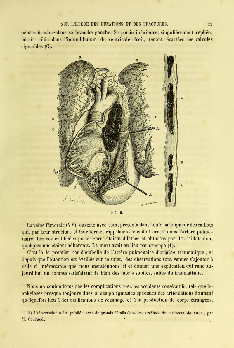 pénétrait même dans sa branche gauche. Sa partie inférieure, singulièrement repliée, taisait saillie dans l’infundibulum du ventricule droit, tenant écartées les valvules sigmoïdes (C). Fig. 9. La veine fémorale (VV), ouverte avec soin, présenta dans toute sa longueur des caillots qui, par leur structure et leur forme, rappelaient le caillot arrêté dans l’artère pulmo- naire. Les veines tibiales postérieures étaient dilatées et obturées par des caillots dont quelques-uns étaient adhérents. La mort avait eu lieu par syncope (1). C’est là le premier cas d’embolie de l’artère pulmonaire d’origine traumatique ; et depuis que l’attention est éveillée sur ce sujet, des observations sont venues s’ajouter à celle si intéressante que nous mentionnons ici et donner une explication qui rend au- jourd’hui un compte satisfaisant de bien des morts subites, suites du traumatisme. Nous ne confondrons pas les complications avec les accidents consécutifs, tels que les ankylosés presque toujours dues à des phlegmasies spéciales des articulations donnant quelquefois lieu à des ossifications de voisinage et à la production de corps étrangers. (1) L’observation a été publiée avec de grands détails dans les Archives de médecine de 1861 , par M. Gouraud.