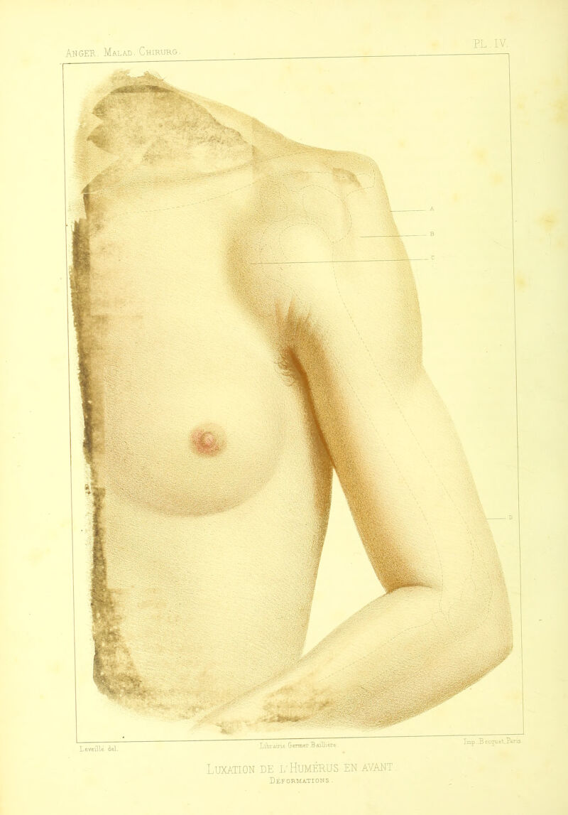 ANGER. Malad. Chirurg. Luxation de l'Humérus en avant. Déformations .