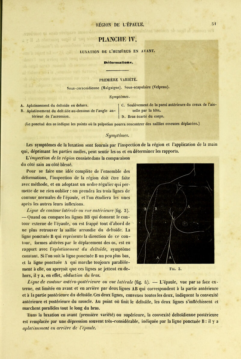 PLANCHE IV. LUXATION DE L’HUMÉRUS EN AVANT. Déformation s. PREMIÈRE VARIÉTÉ. Sous-coracoïdienne (Malgaigne). Sous-scapulaire (Velpeau). Symptômes. C. Soulèvement de la paroi antérieure du creux de l’ais- selle par la tête. D. Bras écarté du corps. (Le ponctué des os indique les points où la palpation pourra rencontrer des saillies osseuses déplacées.) A. Aplatissement du deltoïde en dehors. B. Aplatissement du deltoïde au-dessous de l’angle an térieur de Tacromion. Symptômes. Les symptômes de la luxation sont fournis par l’inspection de la région et l’application de la main qui, déprimant les parties molles, peut sentir les os et eu déterminer les rapports. L’inspection de la région consistedans la comparaison du côté sain au côté blessé. Pour se faire une idée complète de l’ensemble des déformations, l’inspection de la région doit être faite avec méthode, et en adoptant un ordre régulier qui per- mette de ne rien oublier : on prendra les trois lignes de contour normales de l’épaule, et l’on étudiera les unes après les autres leurs inflexions. Ligne de contour latérale ou nue antérieure (fig. 3). — Quand on compare les lignes BB qui donnent leçon- tour externe de l’épaule, on est frappé tout d’abord de ne plus retrouver la saillie arrondie du deltoïde. La ligne ponctuée B qui représente la direction de ce con- tour, formes altérées par le déplacement des os, est en rapport avec l'aplatissement du deltoïde, symptôme constant. Si l’on suit la ligne ponctuée B un peu plus bas, et la ligne ponctuée A qui marche toujours parallèle- ment à elle, on aperçoit que ces lignes se jettent en de- hors, il y a, en effet, abduction du bras. Ligne de contour antéro-postérieure ou vue latérale (fig. h). — L’épaule, vue par sa face ex- terne, est limitée en avant et en arrière par deux lignes AB qui correspondent à la partie antérieure et à la partie postérieure du deltoïde. Ces deux lignes, convexes toutes les deux, indiquent la convexité antérieure et postérieure du muscle. Au point où finit le deltoïde, les deux lignes s’infléchissent et marchent parallèles tout le long du bras. Dans la luxation en avant (première variété) ou supérieure, la convexité deltoïdienne postérieure est remplacée par une dépression souvent très-considérable, indiquée par la ligne ponctuée B : il y a aplatissement en arriére de l’épaule.