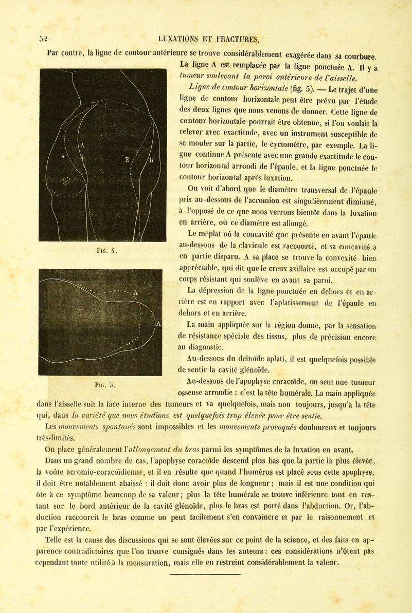 Par contre, la ligne de contour antérieure se trouve considérablement exagérée dans sa courbure. La ligne A est remplacée par la ligne ponctuée A. Il y a tumeur soulevant la paroi antérieure de l'aisselle. L igne de contour horizontale (fig. 5). — Le trajet d’une ligne de contour horizontale peut être prévu par l’étude des deux lignes que nous venons de donner. Cette ligne de contour horizontale pourrait être obtenue, si l’on voulait la relever avec exactitude, avec un instrument susceptible de se mouler sur la partie, le cyrtomètre, par exemple. La li- gne continue A présente avec une grande exactitude le con- tour horizontal arrondi de l’épaule, et la ligne ponctuée le contour horizontal après luxation. On voit d’abord que le diamètre transversal de l’épaule pris au-dessous de l’acromion est singulièrement diminué, à l’opposé de ce que nous verrons bientôt dans la luxation en arrière, où ce diamètre est allongé. Le méplat où la concavité que présente en avant l’épaule au-dessous de la clavicule est raccourci, et sa concavité a en partie disparu. A sa place se trouve la convexité bien appréciable, qui dit que le creux axillaire est occupé par un corps résistant qui soulève en avant sa paroi. La dépression de la ligne ponctuée en dehors et en ar- rière est en rapport avec l’aplatissement de l’épaule en dehors et en arrière. La main appliquée sur la région donne, par la sensation de résistance spéciale des tissus, plus de précision encore au diagnostic. Au-dessous du deltoïde aplati, il est quelquefois possible de sentir la cavité glénoïde. Au-dessous de l’apophyse coracoïde, on sent une tumeur osseuse arrondie : c’est la tête humérale. La main appliquée dans l’aisselle suit la face interne des tumeurs et va quelquefois, mais non toujours, jusqu’à la tête qui, dans la variété que nous étudions est quelquefois trop élevée pour être sentie. Les mouvements spontanés sont impossibles et les mouvements provoqués douloureux et toujours très-limités. On place généralement Y allongement du Aras parmi les symptômes de la luxation en avant. Dans un grand nombre de cas, l’apophyse coracoïde descend plus bas que la partie la plus élevée, la voûte acromio-coracoïdienne, et il en résulte que quand l’humérus est placé sous cette apophyse, il doit être notablement abaissé : il doit donc avoir plus de longueur ; mais il est une condition qui ôte à ce symptôme beaucoup de sa valeur; plus la tète humérale se trouve inférieure tout en res- tant sur le bord antérieur de la cavité glénoïde, plus le bras est porté dans l’abduction. Or, l’ab- duction raccourcit le bras comme on peut facilement s’en convaincre et par le raisonnement et par l’expérience. Telle est la cause des discussions qui se sont élevées sur ce point de la science, et des faits en ap- parence contradictoires que l’on trouve consignés dans les auteurs : ces considérations n’ôtent pas cependant toute utilité à la mensuration, mais elle en restreint considérablement la valeur.