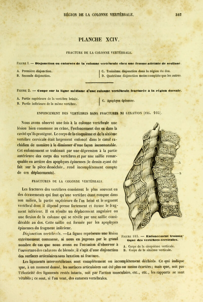 PLANCHE XC1V. FRACTURE DE LA COLONNE VERTÉBRALE. Figure 1.— Disjonction ou entorses de lu colonne A. Première disjonction. B. Seconde disjonction. vertébrale chez une fcuiuieatteinte de scoliose. C. Troisième disjonction dans la région du dos. D. Quatrième disjonction moins complète que les autres Figure 2. — Coupe sur la ligne médiane d'une colonne vertébrale fracturée d la région dorsale. C. Apophyse épineuse. A. Partie supérieure de la vertèbre brisée B. Partie inférieure de la même vertèbre. ENFONCEMENT DES VERTÈBRES SANS FRACTURES NI LUXATION (FIG. 103). Nous avons observé une fois à la colonne vertébrale une lésion bien commune au crâne, l’enfoncement des os dans la cavité qu’ils protègent. Le corps de la cinquième et de la sixième vertèbre cervicale était largement enfoncé dans le canal ra- chidien de manière à le diminuer d’une façon incontestable. Cet enfoncement se trahissait par une dépression à la partie antérieure des corps des vertèbres et par une saillie remar- quable en arrière des apophyses épineuses (le dessin ayant été fait sur la pièce desséchée, rend incomplètement compte de ces déplacements). FRACTURES DE LA COLONNE VERTÉBRALE. Les fractures des vertèbres consistent le plus souvent en des écrasements qui font qu’une vertèbre étant rompue dans son milieu, la partie supérieure de l’os brisé et le segment vertébral dont il dépend presse fortement et écrase le frag- ment inférieur. Il en résulte un déplacement angulaire ou une flexion de la colonne qui se révèle par une saillie consi- dérable au dos. Cette saillie est formée par les apophyses épineuses du fragment inférieur. Disjonction vertébrale. —La figure représente une lésion extrêmement commune, si nous en jugeons par le grand nombre de cas que nous avons eu l’occasion d’observer à l’ouverturedescadavres de blessés;il s’agit d’une disjonction des surfaces articulaires sans luxation ni fracture. Les ligaments intervertébraux sont complètement ou incomplètement déchirés Ce qui indique que, à un moment donné, les surfaces articulaires ont été plus ou moins écartées; mais que, soit par l'élasticité des ligaments restés intacts, soit par l’action musculaire, etc., etc., les rapports se sont ‘rétablis ; ce sont, si l’on veut, des entorses vertébrales. FIGURE 103. — Enfoncement trnumu- tique des vertèbres cervicales. A. Corps de la cinquième verticale. B. Corps de la sixième verticale.