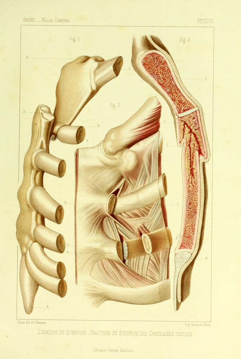 ÂNGER _ Malad. Chirurg. PI’XCVH. Beau del et Chromo. -un» Jaecquet Jrans. Iuxatioit bu Sternum_îRA.cTUEE ru Sternum,des Cariila&es costaux.