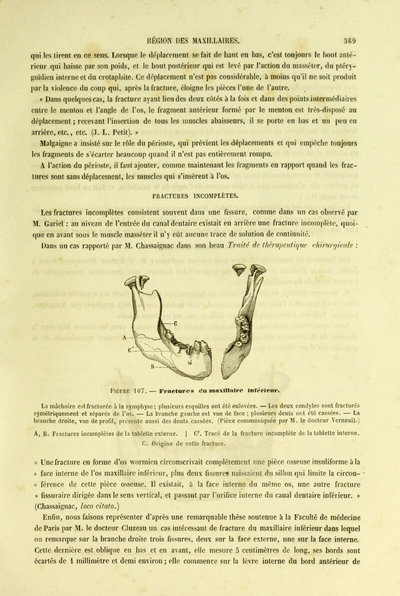 qui les tirent en ce sens. Lorsque le déplacement se fait de liant en bas, c’est toujours le bout anté- rieur qui baisse par son poids, et le bout postérieur qui est levé par l’action du masséter, du ptéry- goïdieu interne et du crotaphite. Ce déplacement n’est pas considérable, à moins qu’il ne soit produit parla violence du coup qui, après la fracture, éloigne les pièces l’une de l’autre. « Dans quelques cas, la fracture ayant lieu des deux côtés à la fois et dans des points intermédiaires entre le menton et l’angle de l’os, le fragment antérieur formé par le menton est très-disposé au déplacement ; recevant l’insertion de tous les muscles abaisseurs, il se porte en bas et un peu en arrière, etc., etc. (J. L. Petit). » Malgaignc a insisté sur le rôle du périoste, qui prévient les déplacements cl qui empêche toujours les fragments de s’écarter beaucoup quand il n’est pas entièrement rompu. A l’action du périoste, il faut ajouter, comme maintenant les fragments en rapport quand les frac- tures sont sans déplacement, les muscles qui s’insèrent à l’os. FRACTURES INCOMPLÈTES. Les fractures incomplètes consistent souvent dans une fissure, comme dans un cas observé par M. Gariel : au niveau de l’entrée du canal dentaire existait en arrière une fracture incomplète, quoi- que en avant sous le muscle masséter il n’y eût aucune trace de solution de continuité. Dans un cas rapporté par M. Chassaignac dans son beau Traite de thérapeutique chimrgicale : FIGURE 107. — Fractures «lu maxillaire inférieur. La mâchoire est fracturée à la symphyse; plusieurs esquilles ont été enlevées. — Les deux condyles sont fracturés symétriquement et séparés de l’os. — La branche gauche est vue de face ; plusieurs dents ont été cassées. — La branche droite, vue de profil, présente aussi des dents cassées. (Pièce communiquée par M. le docteur Yerneui].) A, B. Fractures incomplètes de la tablette externe. | U. Tracé de la fracture incomplète de la tablette interne. C. Origine de cette fracture. « Une fracture en forme d’os wormien circonscrivait complètement une pièce osseuse insuliforme à la » face interne de l’os maxillaire inférieur, plus deux fissures naissaient du sillon qui limite la circon- » férence de cette pièce osseuse. Il existait, 5 la face interne du même os, une autre fracture » fissuraire dirigée dans le sens vertical, et passant par l’orifice interne du canal dentaire inférieur. » (Chassaignac, loco citato.) Enfin, nous faisons représenter d’après une remarquable thèse soutenue à la Faculté de médecine de Paris par M. le docteur Cluzeau un cas intéressant de fracture du maxillaire inférieur dans lequel on remarque sur la branche droite trois fissures, deux sur la face externe, une sur la face interne. Cette dernière est oblique en bas et en avant, elle mesure 5 centimètres de long, ses bords sont écartés de 1 millimètre et demi environ ; elle commence sur la lèvre interne du bord antérieur de