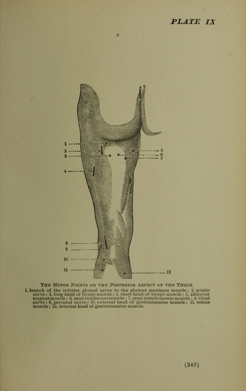 The Motor Points on the Posterior Aspect of the Thigh. 1, branch of the inferior gluteal nerve to the gluteus maximus muscle; 2, sciatic nerve ; 3, long head of biceps muscle; 4, short head of biceps muscle ; 5, adductor magnusmuscle; 6, semi-tendinosus muscle : 7, semi-membranosus muscle ; 8, tibial nerve; 9, peroneal nerve; 10, external head of gastrocnemius muscle; 11, soleus muscle ; 12, internal head of gastrocnemius muscle.