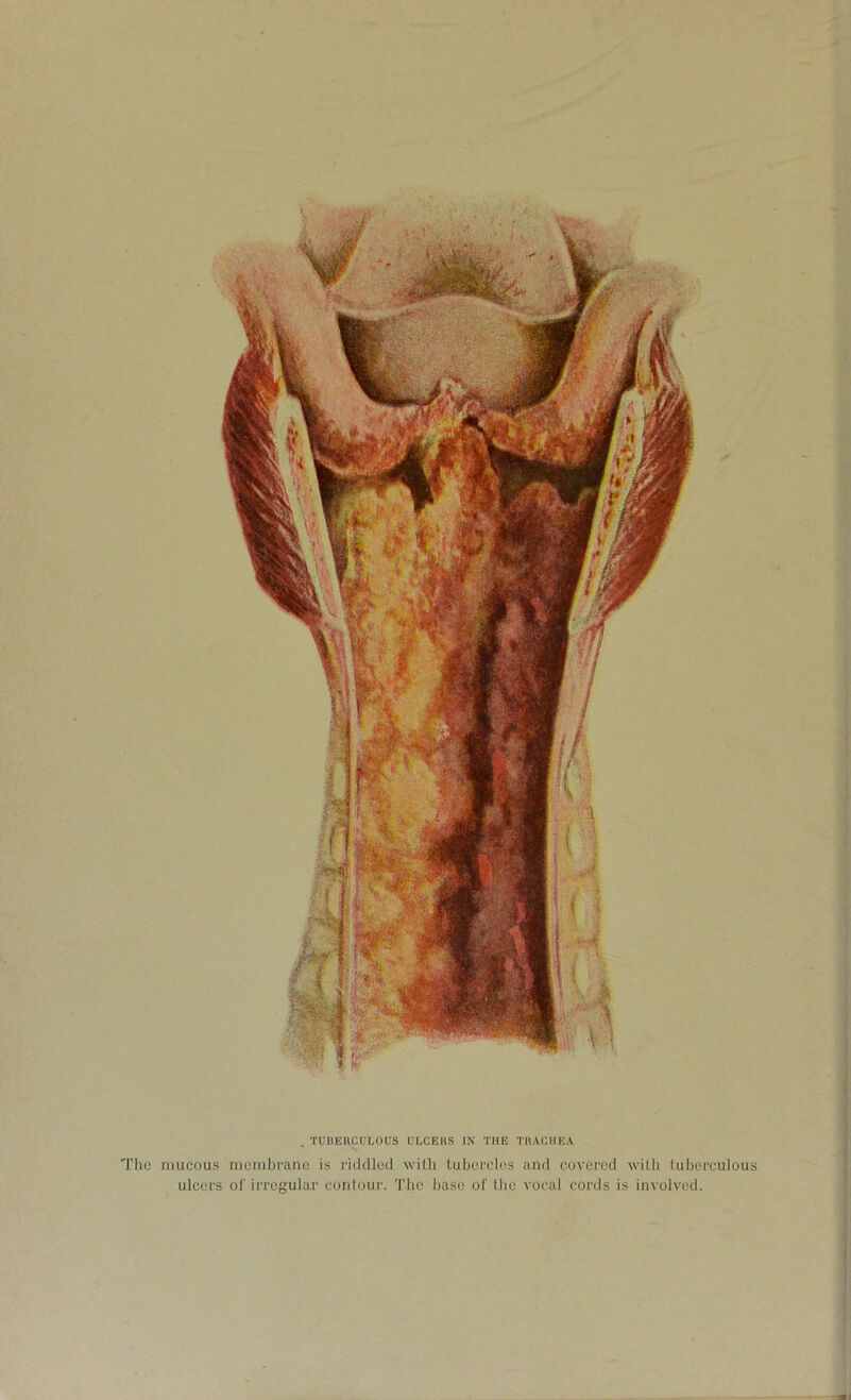 The mucous membrane is riddled, with tubercles and covered with tuberculous ulcers of irregular contour. The base of the vocal cords is involved.