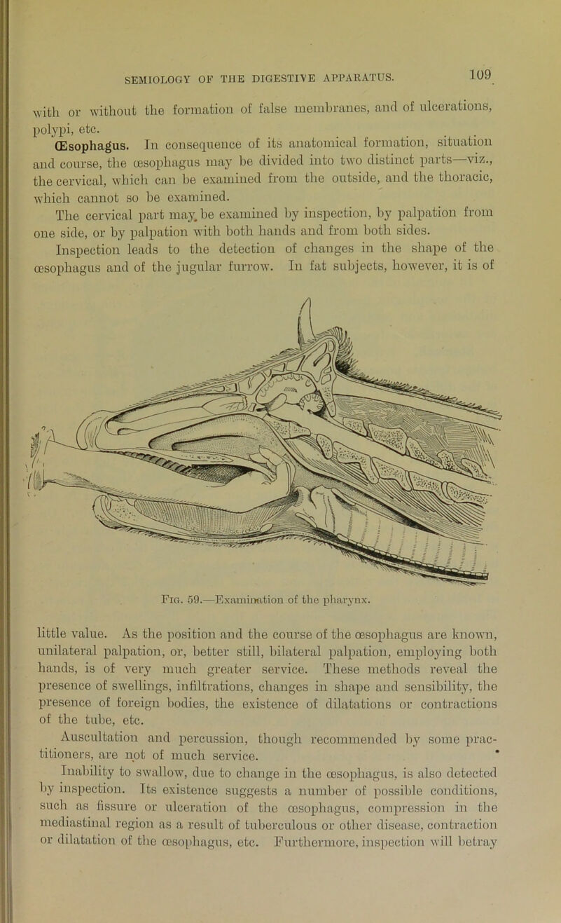 with or without the formation of false membranes, and of ulcerations, polypi, etc. (Esophagus. In consequence of its anatomical formation, situation and course, the oesophagus may be divided into two distinct parts—viz., the cervical, which can be examined from the outside, and the thoracic, which cannot so be examined. The cervical part may. be examined by inspection, by palpation from one side, or by palpation with both hands and from both sides. Inspection leads to the detection of changes in the shape of the oesophagus and of the jugular furrow. In fat subjects, however, it is of Fig. 59.—Examination of the pharynx. little value. As the position and the course of the oesophagus are known, unilateral palpation, or, better still, bilateral palpation, employing both hands, is of very much greater service. These methods reveal the presence of swellings, infiltrations, changes in shape and sensibility, the presence of foreign bodies, the existence of dilatations or contractions of the tube, etc. Auscultation and percussion, though recommended by some prac- titioners, are not of much service. Inability to swallow, due to change in the oesophagus, is also detected by inspection. Its existence suggests a number of possible conditions, such as fissure or ulceration of the oesophagus, compression in the mediastinal region as a result of tuberculous or other disease, contraction or dilatation of the oesophagus, etc. Furthermore, inspection will betray