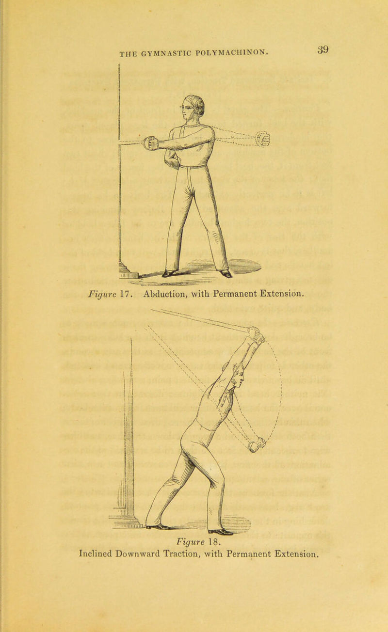 Figure 18. Inclined Downward Traction, with Permanent Extension.