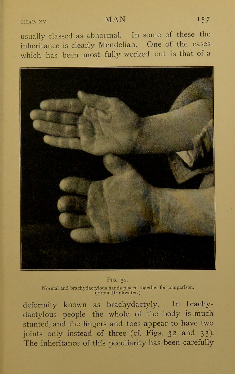 usually classed as abnormal. In some of these the inheritance is clearly Mendelian. One of the cases which has been most fully worked out is that of a Fig. 32. Normal and brachydactylous hands placed together for comparison. (From Drinkwater.) deformity known as brachydactyly. In brachy- dactylous people the whole of the body is much stunted, and the fingers and toes appear to have two joints only instead of three (cf. Figs. 32 and 33). The inheritance of this peculiarity has been carefully