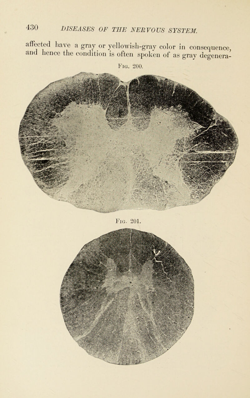 affected have a gray or yellowisli-gray color in consequence, and hence the condition is often spoken of as gray degenera- Fig. 200. Fig. 201.