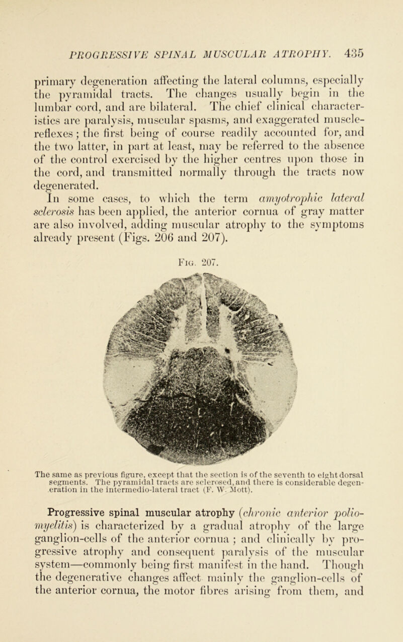 primary degeneration affecting the lateral columns, especially the pyramidal tracts. The changes usually begin in the lumbar cord, and are bilateral. The chief clinical character- istics are paralysis, muscular spasms, and exaggerated muscle- reflexes ; the first being of course readily accounted for, and the two latter, in part at least, may be referred to the absence of the control exercised by the higher centres upon those in the cord, and transmitted normally through the tracts now degenerated. In some cases, to which the term amyotrophic lateral sclerosis has been applied, the anterior cornua of gray matter are also involved, adding muscular atrophy to the symptoms already present (Figs. 206 and 207). Fig. 207. The same as previous figure, except that the section is of tire seventh to ei^ht dorsal segments. The pyramidal tracts are sclerosed, and there is considerable degen- eration in the intermedio-lateral tract (F. W. Mott). Progressive spinal muscular atrophy (chronic anterior polio- myelitis) is characterized by a gradual atrophy of the large ganglion-cells of the anterior cornua ; and clinically by pro- gressive atrophy and consequent paralysis of the muscular system—commonly being first manifest in the hand. Though the degenerative changes affect mainly the ganglion-cells of the anterior cornua, the motor fibres arising from them, and